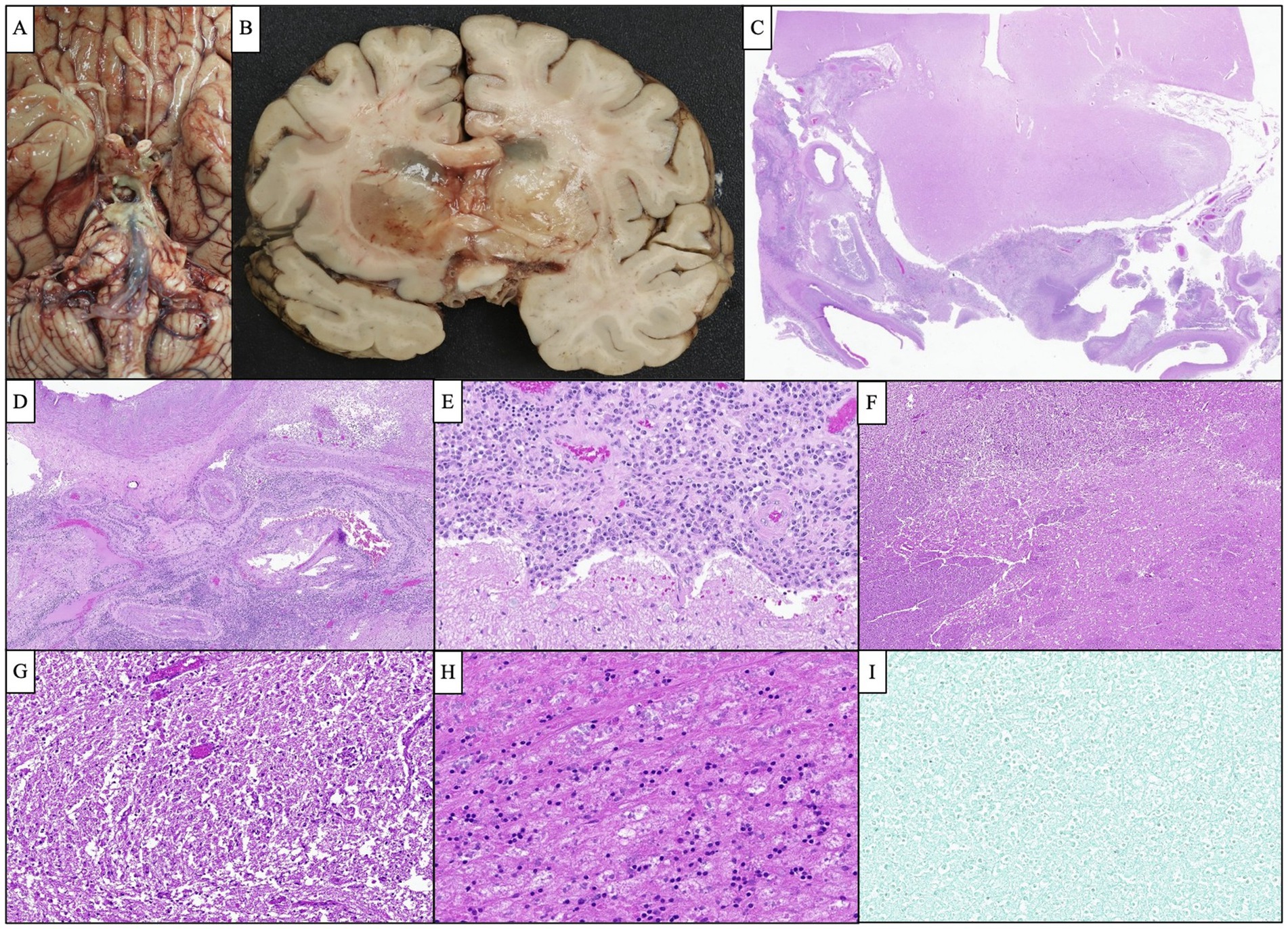 Panel A shows the base of the brain with visible vasculature. Panel B displays a horizontal slice of the brain with dark lesions in both hemispheres. Panels C to I depict various histological views under a microscope. Panel C shows a large section with differing tissue densities. Panel D displays a swirled pattern of tissues. Panel E presents densely packed cells with purple staining. Panel F shows a network of lighter branching structures. Panel G features a dense, irregular pattern of cells. Panel H shows spindle-shaped cells with dark nuclei. Panel I contains a uniform lighter stained pattern.