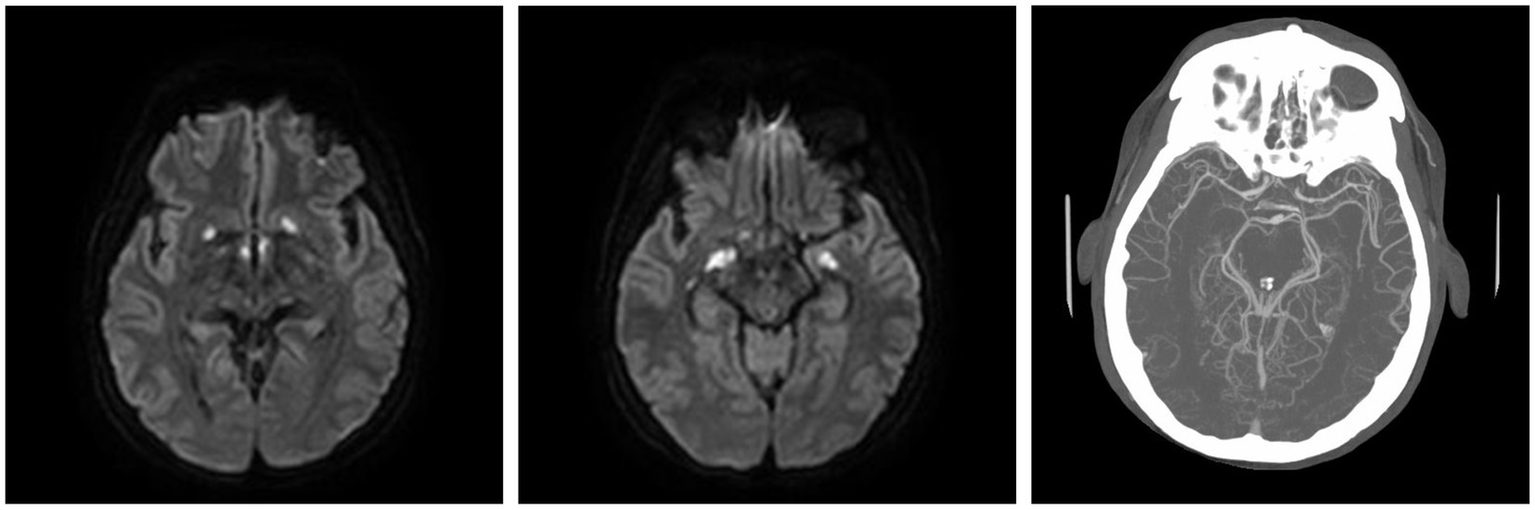 Three-panel image showing brain scans. The first two panels are MRI scans in grayscale, highlighting brain structures. The third panel is a CT scan with higher contrast, emphasizing bone and blood vessels.