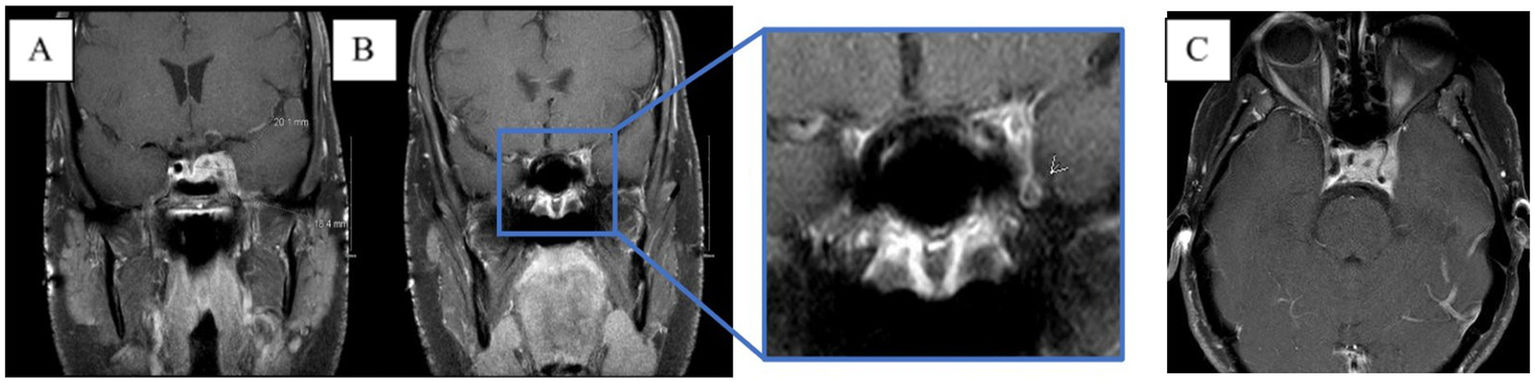 MRIs of the brain labeled A, B, and C. Image A and B show coronal views with measurements. B includes a magnified inset highlighting a specific area. Image C is an axial view.