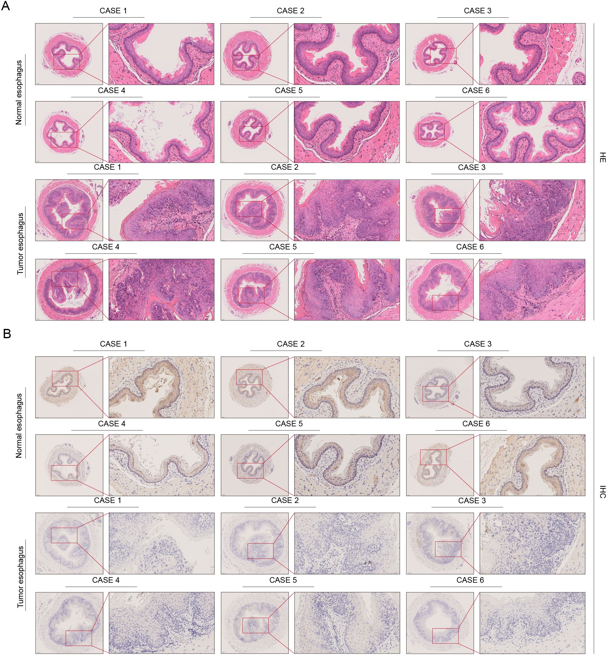 Panel A displays histological slides showing normal and tumor esophagus tissue. Cases one to six are compared, with magnified insets. Normal tissue appears orderly, while tumor samples show disorganization and increased cellularity. Panel B presents immunohistochemical stained slides of the same cases. Normal esophageal tissue shows specific staining patterns, while tumor tissues have reduced or absent staining, indicating differences in protein expression between normal and tumor esophageal tissue.