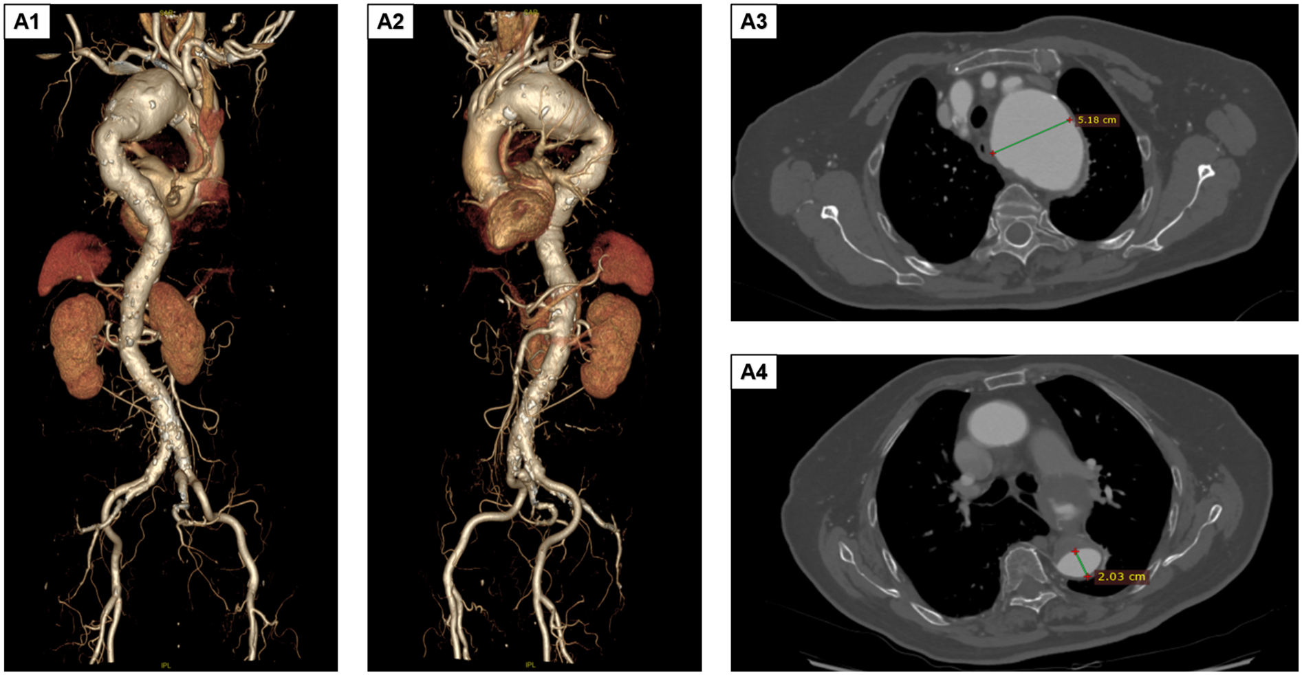 Four-panel medical imaging showing vascular structures. Panels A1 and A2 are 3D renderings of the abdominal aorta and kidneys. Panels A3 and A4 are cross-sectional CT scans of the chest, highlighting measurements of 5.18 centimeters and 2.03 centimeters in diameter, respectively.