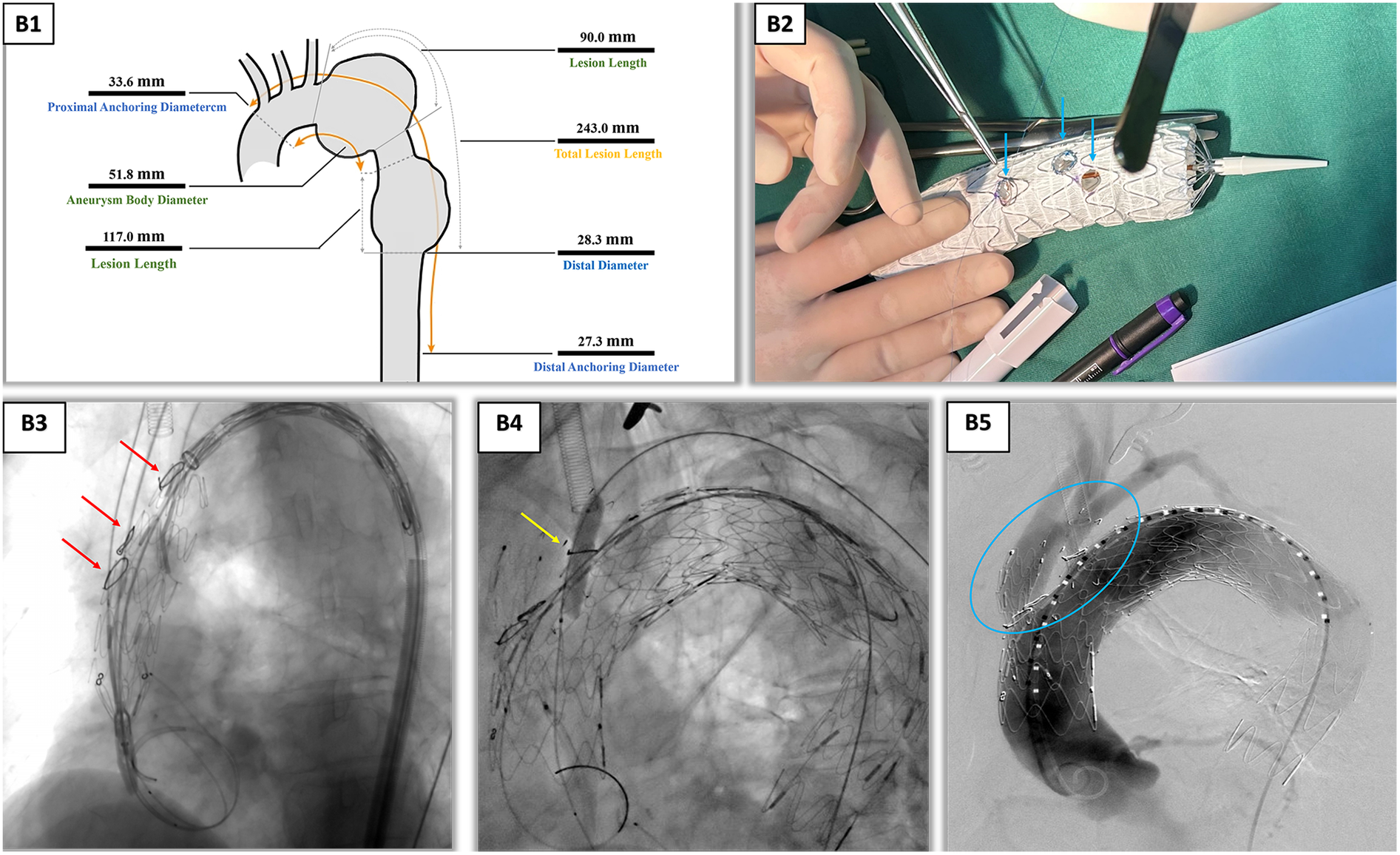 Diagram and series of images related to a medical procedure. B1 shows a diagram of the thoracic aorta with various measurements labeled: proximal anchoring diameter, aneurysm body diameter, lesion lengths, and distal anchoring and diameter. B2 shows hands manipulating a stent graft, with blue arrows pointing to specific areas. B3, B4, and B5 are X-ray images of stent deployment in the aorta, with red and yellow arrows indicating parts of the structure and a blue circle highlighting a section in B5.