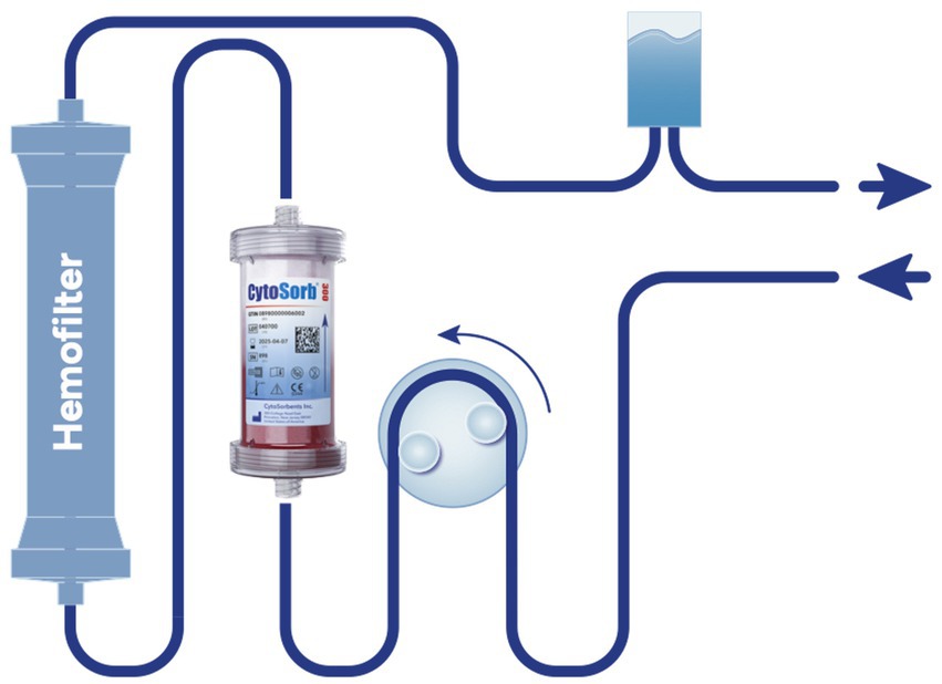 Diagram of a hemofiltration system with labeled components. Blood flows through a hemofilter, passes through a device labeled