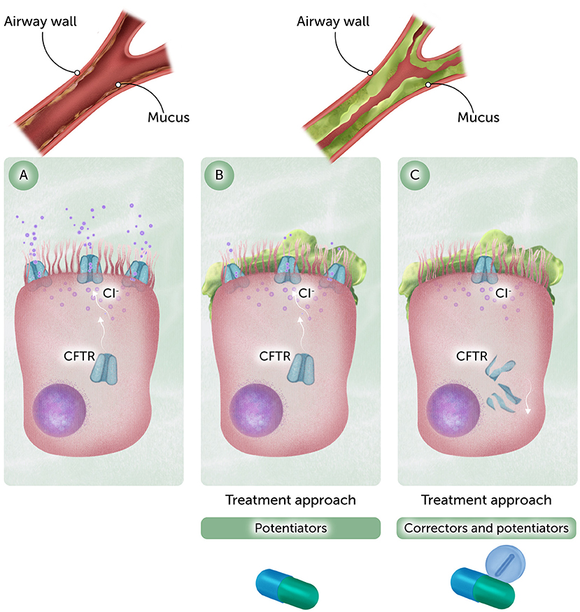 Three-panel illustration showing CFTR protein in airway cells. Panel A depicts a healthy airway with normal mucus flow. Panels B and C show obstructed airways with mucus buildup. Panel B presents treatment with potentiators, and Panel C combines correctors and potentiators. Each treatment approach includes corresponding medication icons, explaining their effects on chloride ion (Cl-) flow and CFTR function. Top insets compare normal and blocked airways with labels indicating mucus presence.
