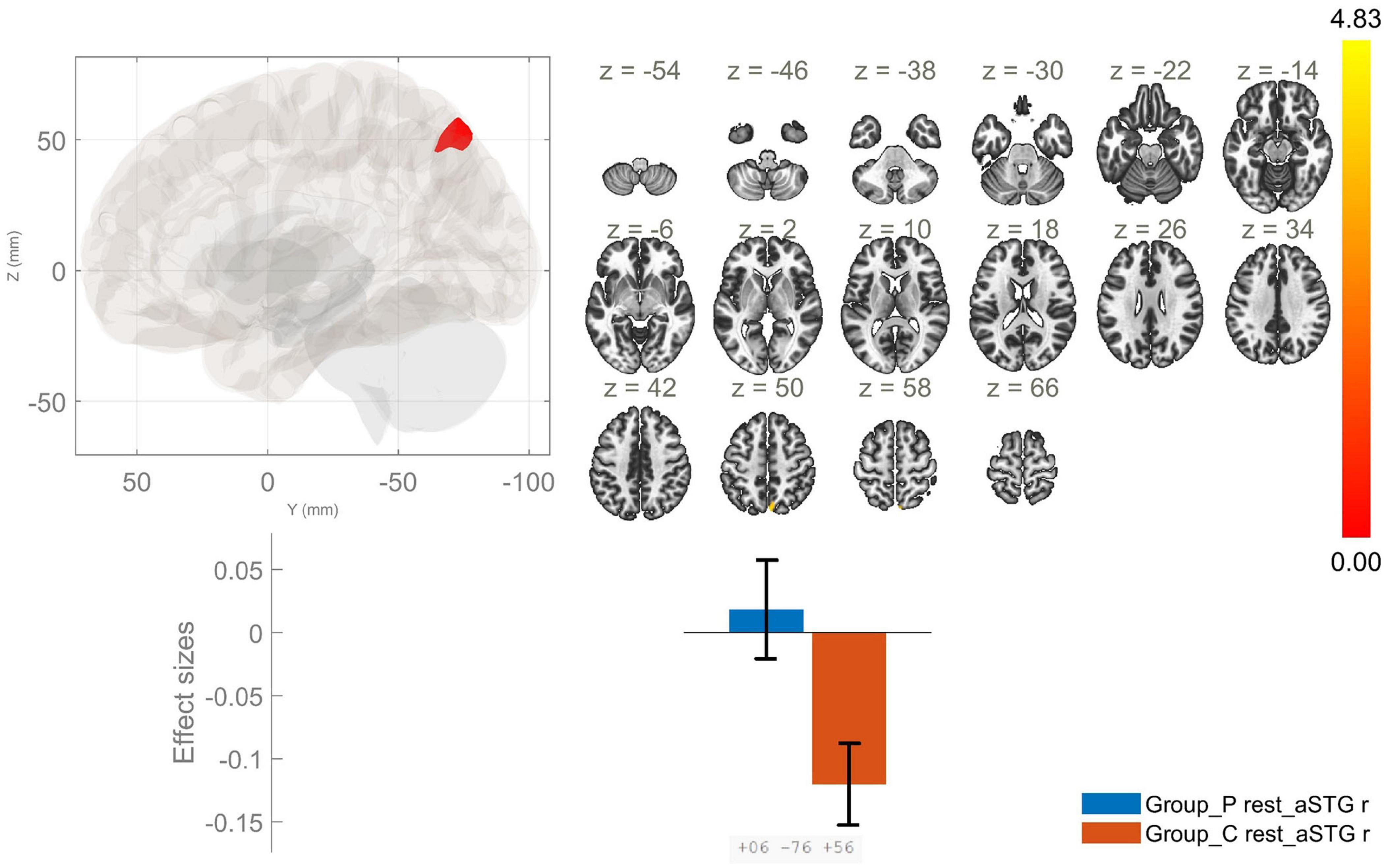 Brain imaging visualization including a sagittal brain view with a highlighted region, multiple axial brain slices labeled with z-coordinates, a color scale from red to yellow, and a bar graph showing effect sizes for Group_P and Group_C with corresponding colors blue and orange.