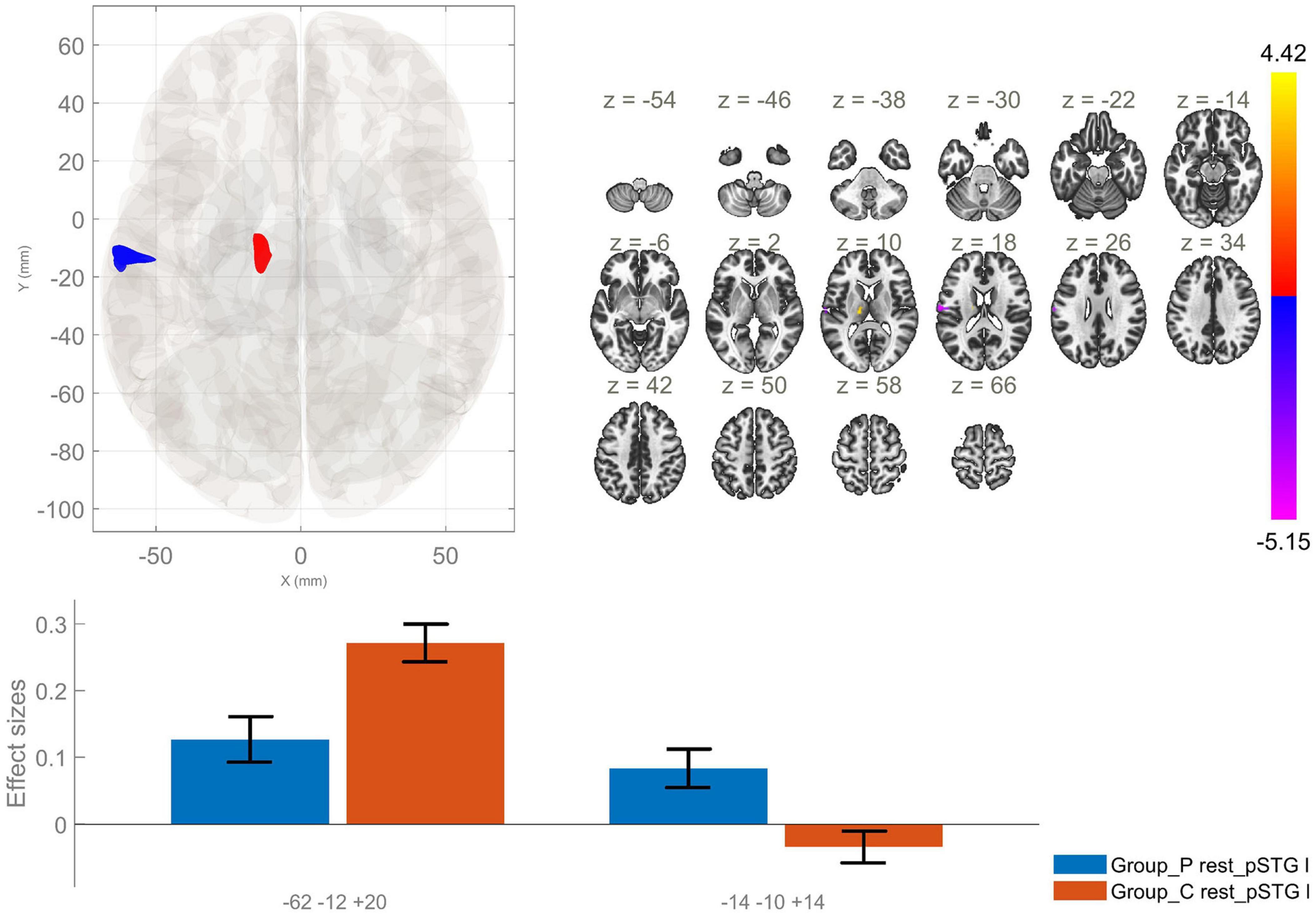 MRI brain imaging with slices at various z-levels shows color-coded regions of interest on the left. A bar graph below compares effect sizes for two groups, with blue and orange bars representing “Group_P_rest_pSTG” and “Group_C_rest_pSTG,” respectively. A vertical color scale indicates intensity levels from −5.15 to 4.42.
