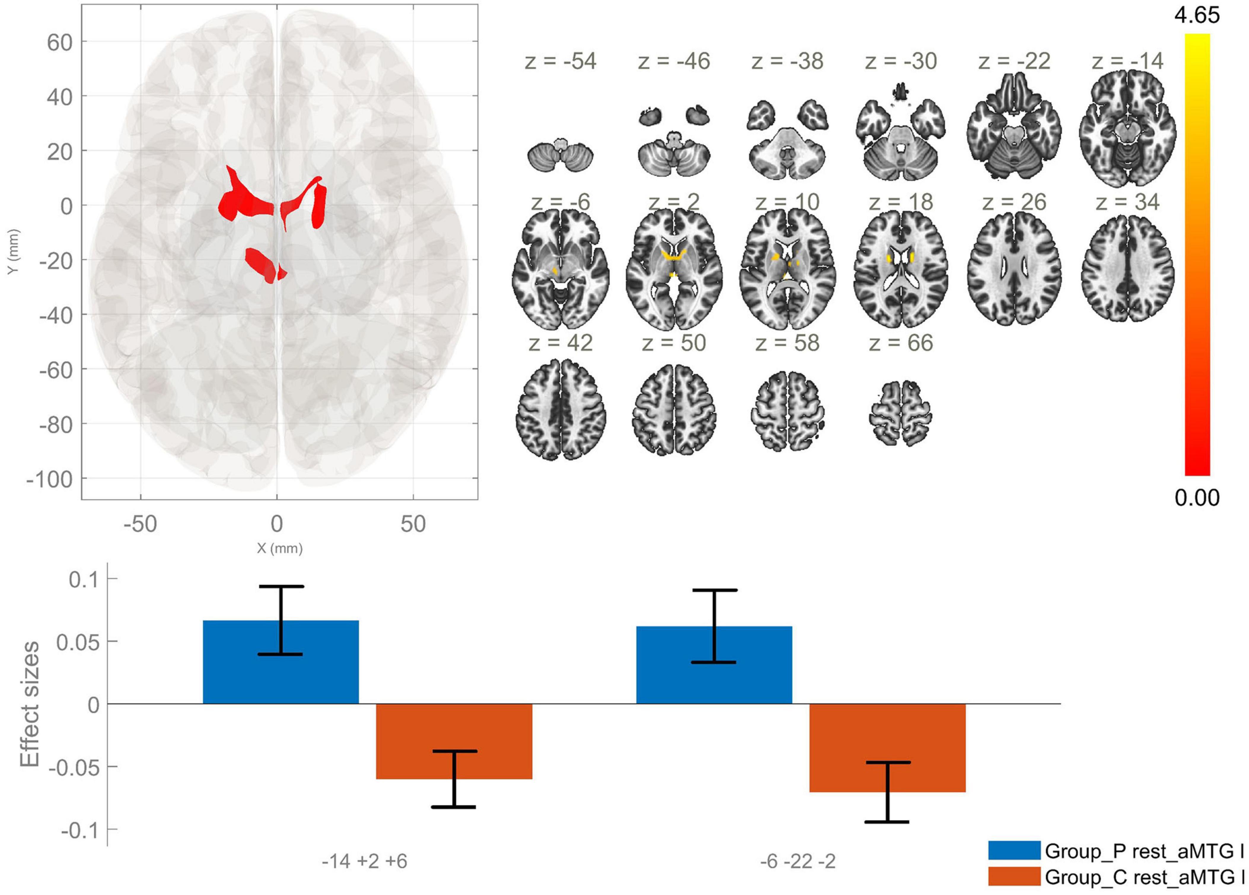Brain imaging analysis showing activation areas highlighted in red on brain slices at various z-coordinates from −54 to 66. A color scale from red to yellow indicates activation intensity from 0.00 to 4.65. Below, a bar graph compares effect sizes between two groups (Group_P rest_aMTG I and Group_C rest_aMTG I) at coordinates −14 +2 +6 and −6 −22 −2. Blue bars represent Group_P, and orange bars represent Group_C, with Group_P showing positive effect sizes and Group_C negative.