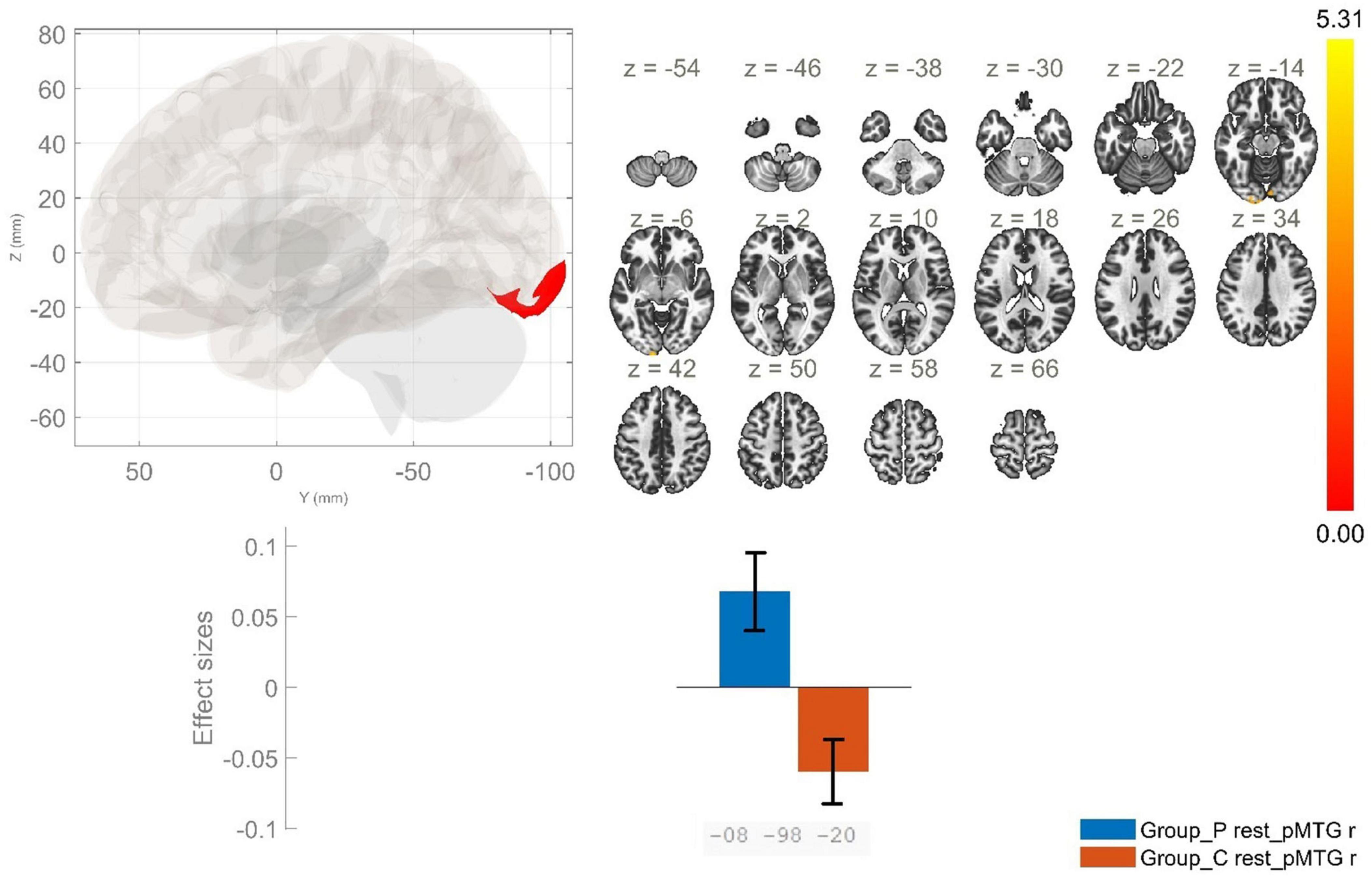 Brain imaging results include a sagittal view highlighting a red region, axial slices with variations at different z-coordinates, and a color scale from red to yellow indicating intensity. Below, a bar graph compares effect sizes for two groups, Group_P in blue and Group_C in orange, each with error bars.