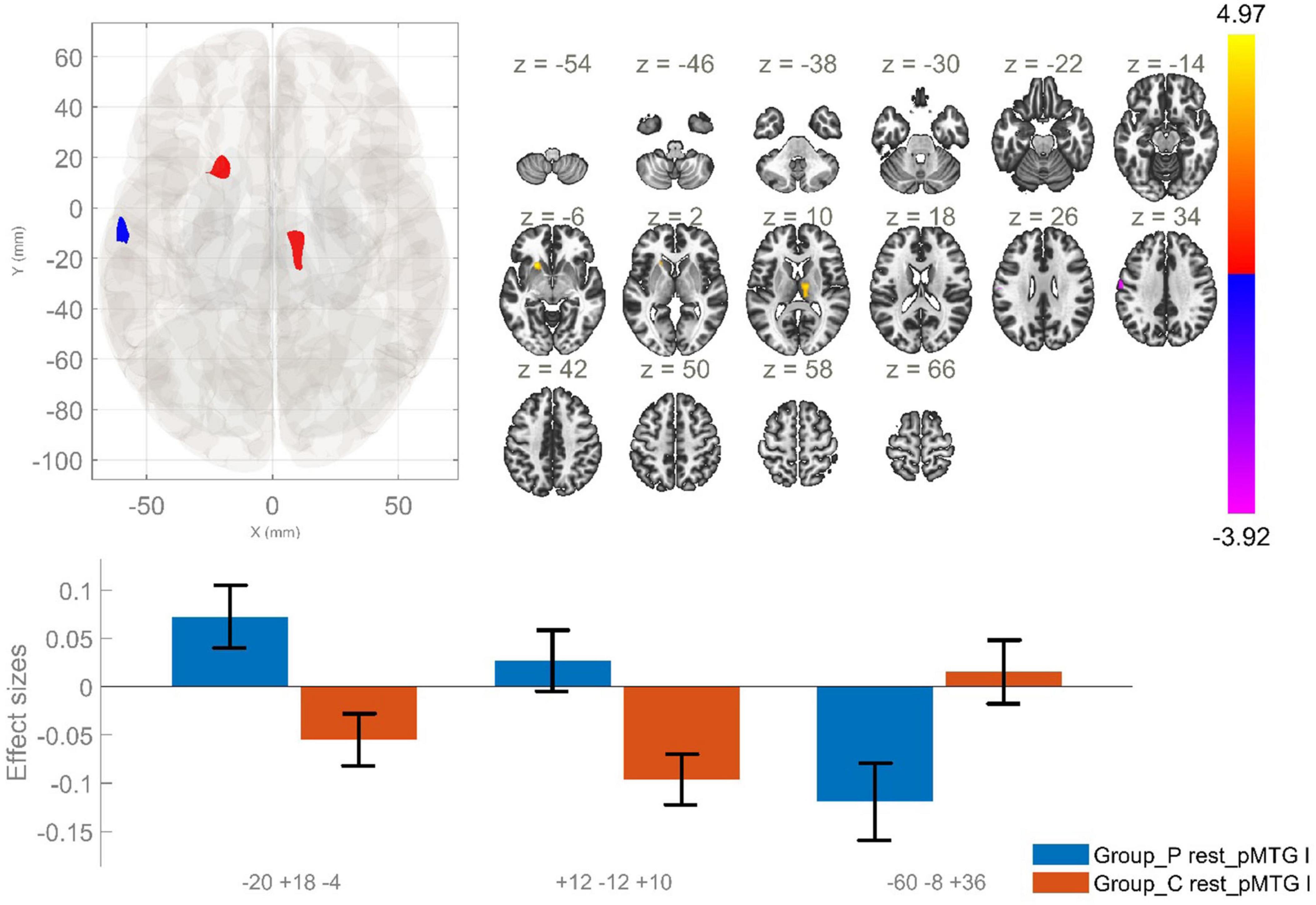 Brain imaging results include MRI scans with highlighted areas in blue and red, corresponding to different effect sizes and brain regions across various slices labeled by z-coordinates. A color scale indicates values from -3.92 to 4.97. Below, a bar chart presents effect sizes for two groups, Group_P and Group_C, with different brain regions on the x-axis and values on the y-axis. Bars represent positive and negative effects, highlighted in blue and orange with error bars.