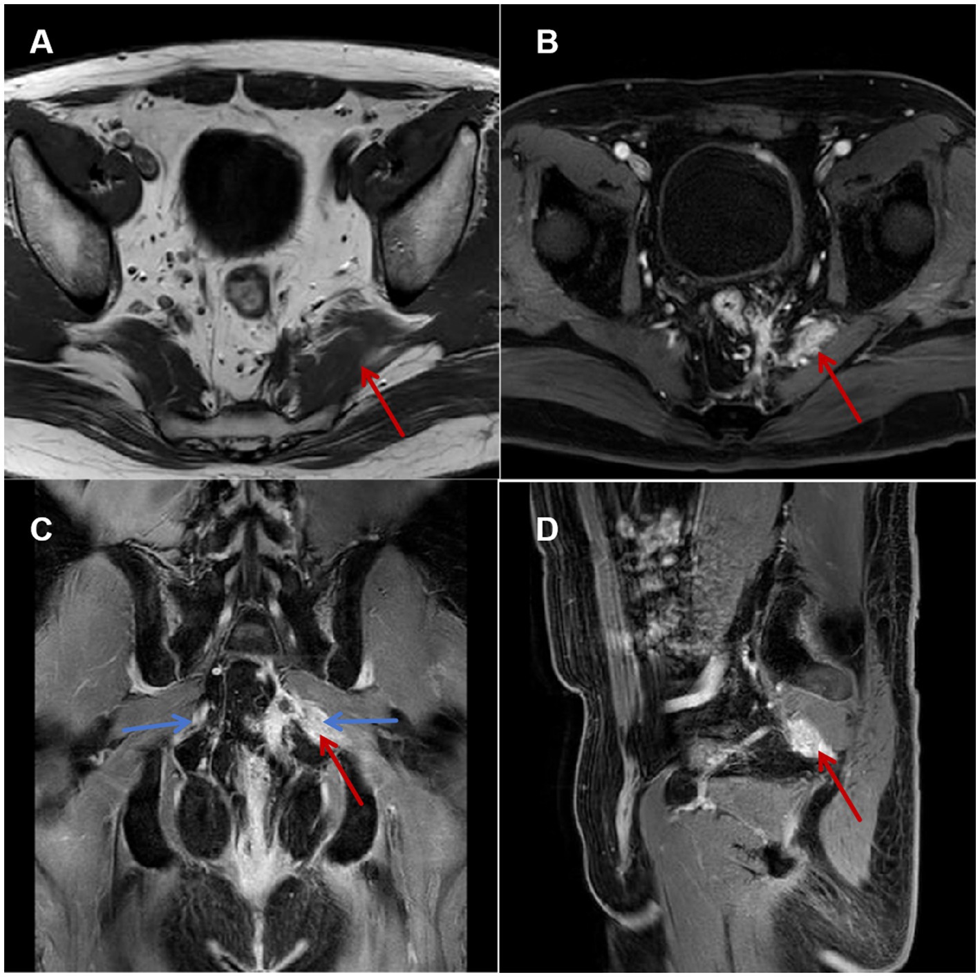 MRI images of the pelvic region. Panel A: Axial T1-weighted image with a red arrow pointing to a potential abnormality. Panel B: Axial T2-weighted image with a red arrow indicating a focal area. Panel C: Coronal T2-weighted image with a red arrow highlighting an area of interest and blue arrows showing additional features. Panel D: Sagittal T2-weighted image with a red arrow pointing to a specific region.