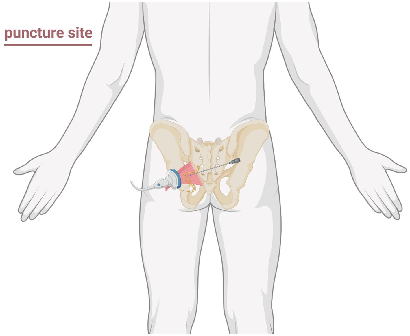 Illustration of a human figure showing the pelvic region with a highlighted puncture site. A medical tool appears to be inserted near the left side of the pelvis for a procedure.