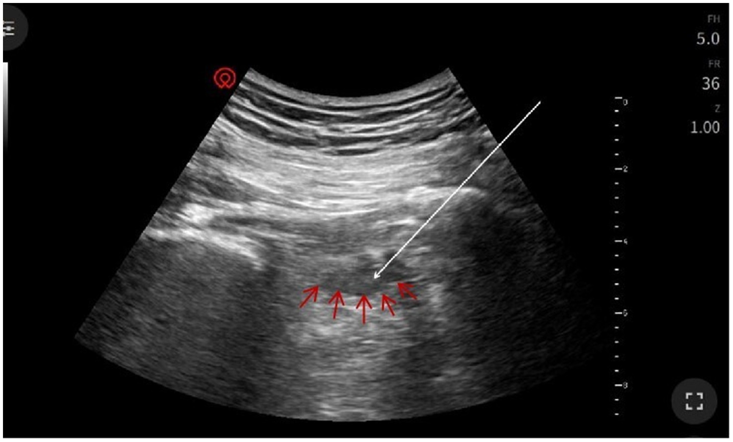 Ultrasound image showing various shades of gray with a white line and several red arrows pointing toward a specific area. Numeric and abbreviative data are visible along the sides.