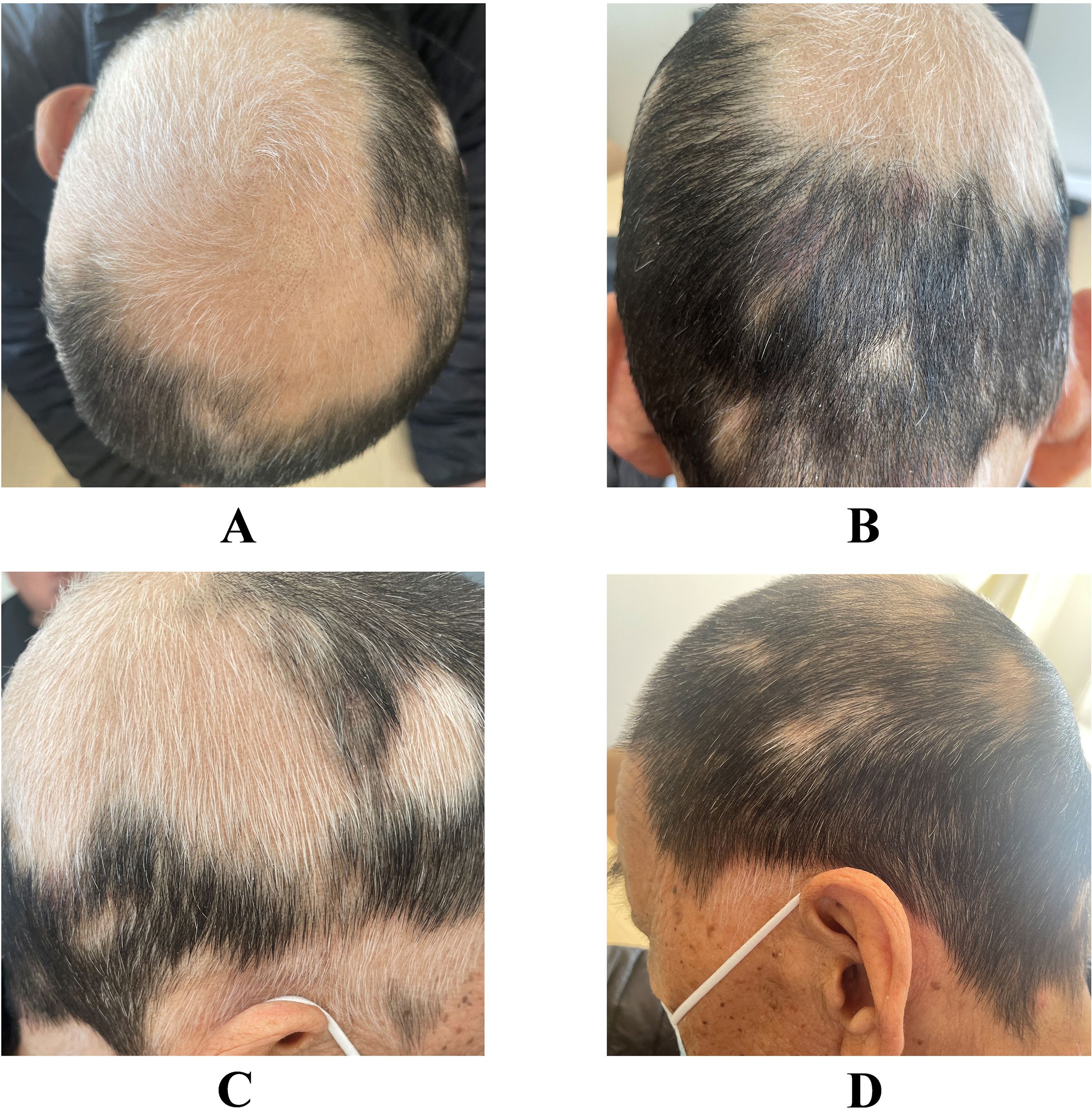 Four images labeled A to D showing the top and sides of a person's head with patchy hair loss. Image A shows extensive hair loss on the top. Image B shows patchy thinning at the back. Image C captures uneven hair distribution from the side. Image D shows less severe thinning on the side with visible patches.