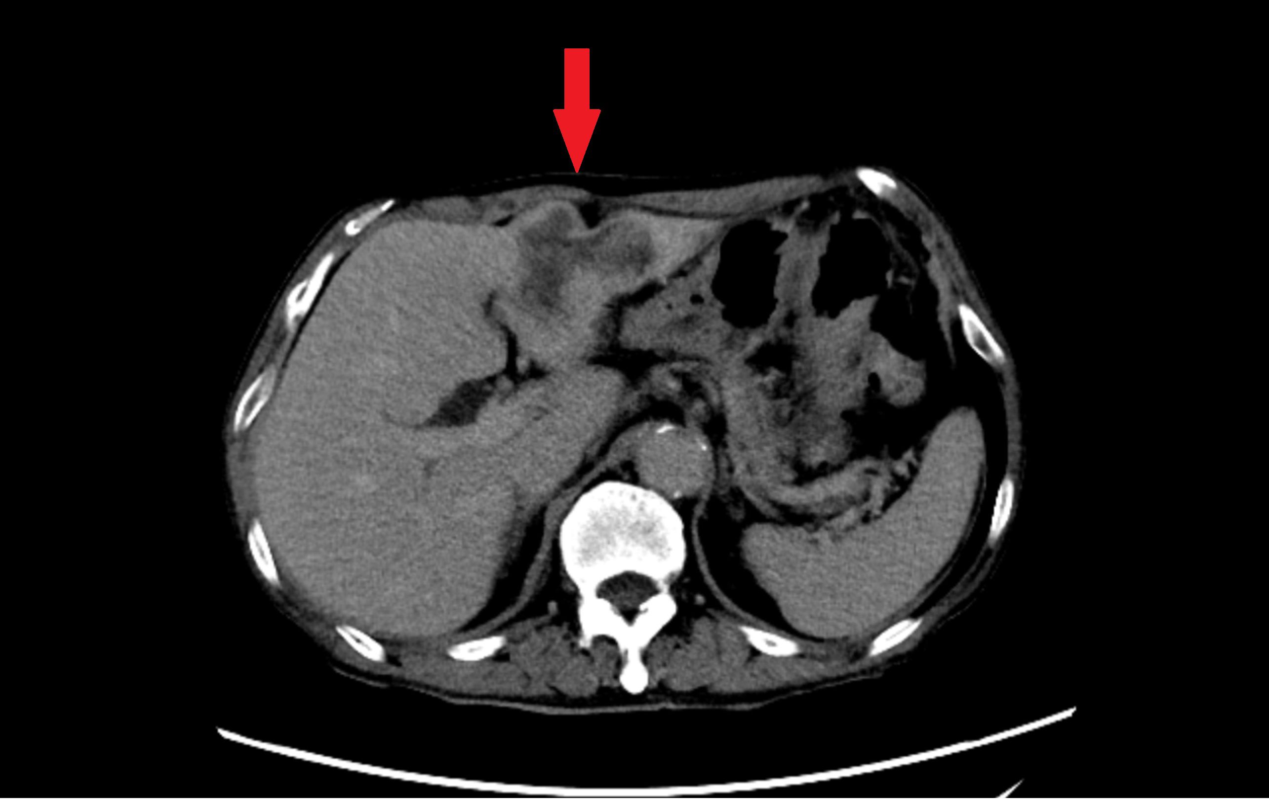CT scan of the abdomen shows a cross-sectional view with a red arrow pointing to a specific area. The scan displays various shades of gray representing different tissue densities.