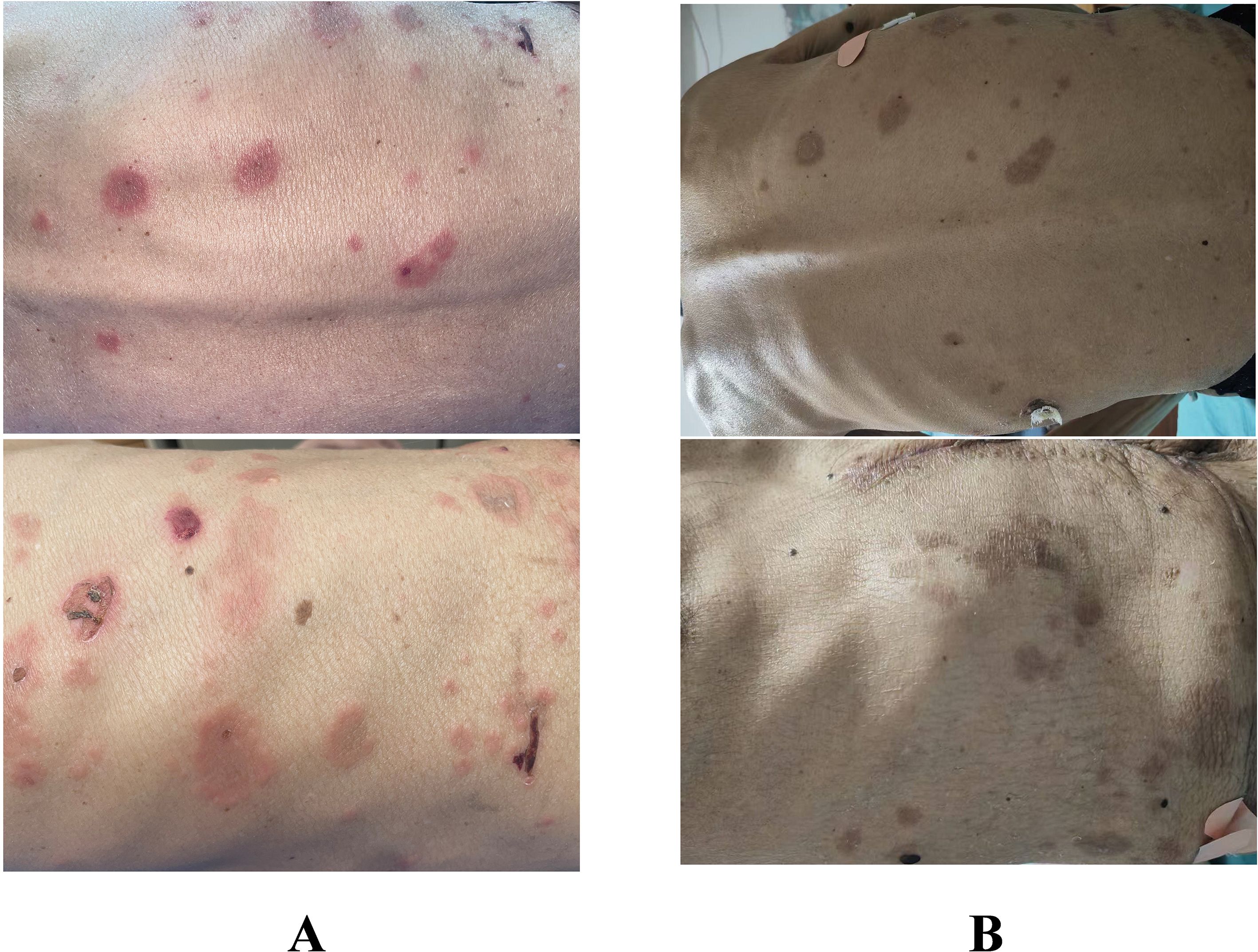 Two panels labeled A and B show close-up views of skin conditions. Panel A features skin with multiple red, inflamed lesions. Panel B shows skin with darker pigmentation and fewer lesions. Both panels illustrate variations in skin texture and coloration.