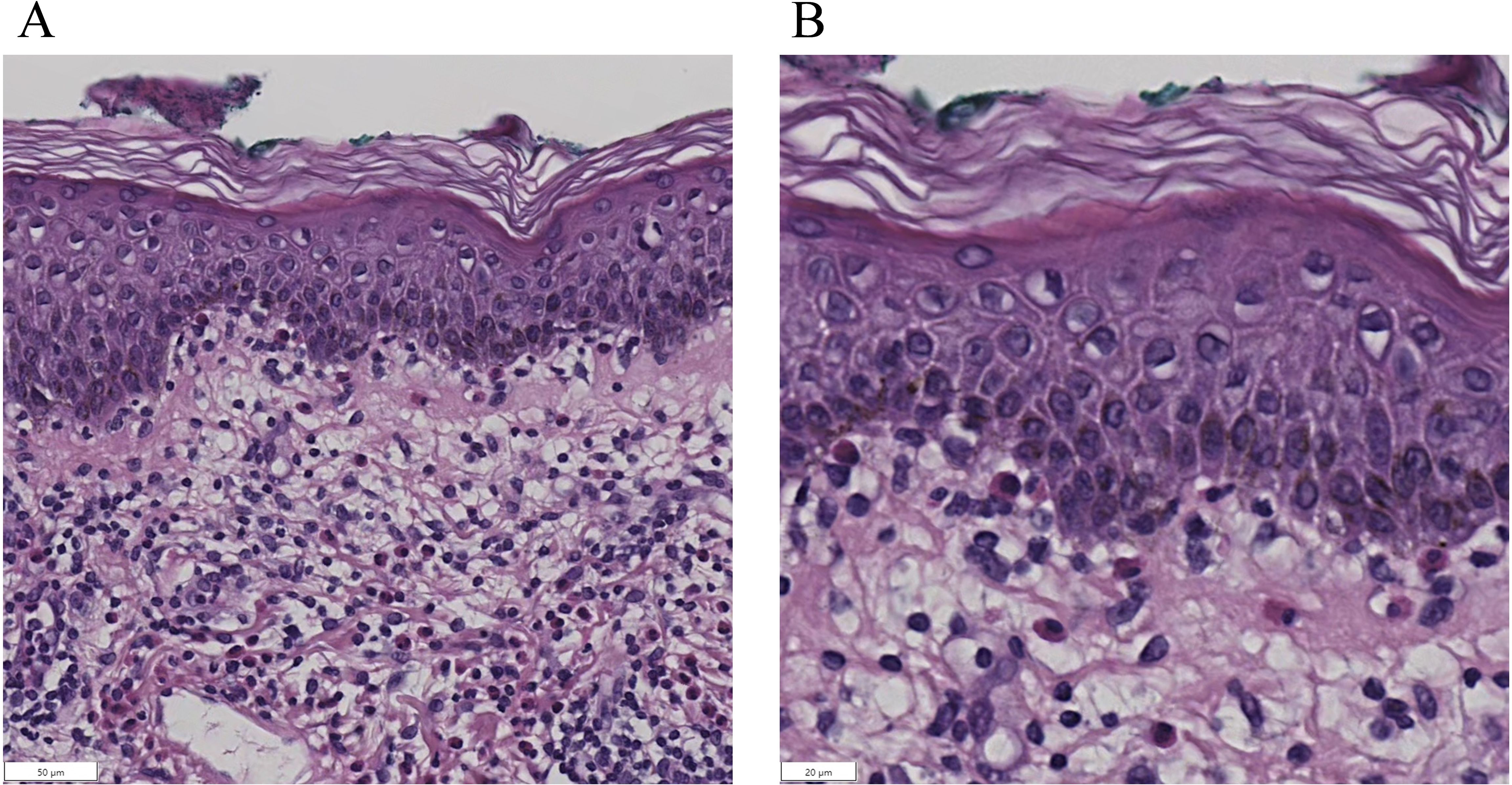 Histological comparison of skin samples, showing epidermis and dermis layers. Panel A presents a wider view with a scale of 50 micrometers, while Panel B offers a closer look at cellular details with a scale of 20 micrometers. Both images display stained cell structures and tissue composition.
