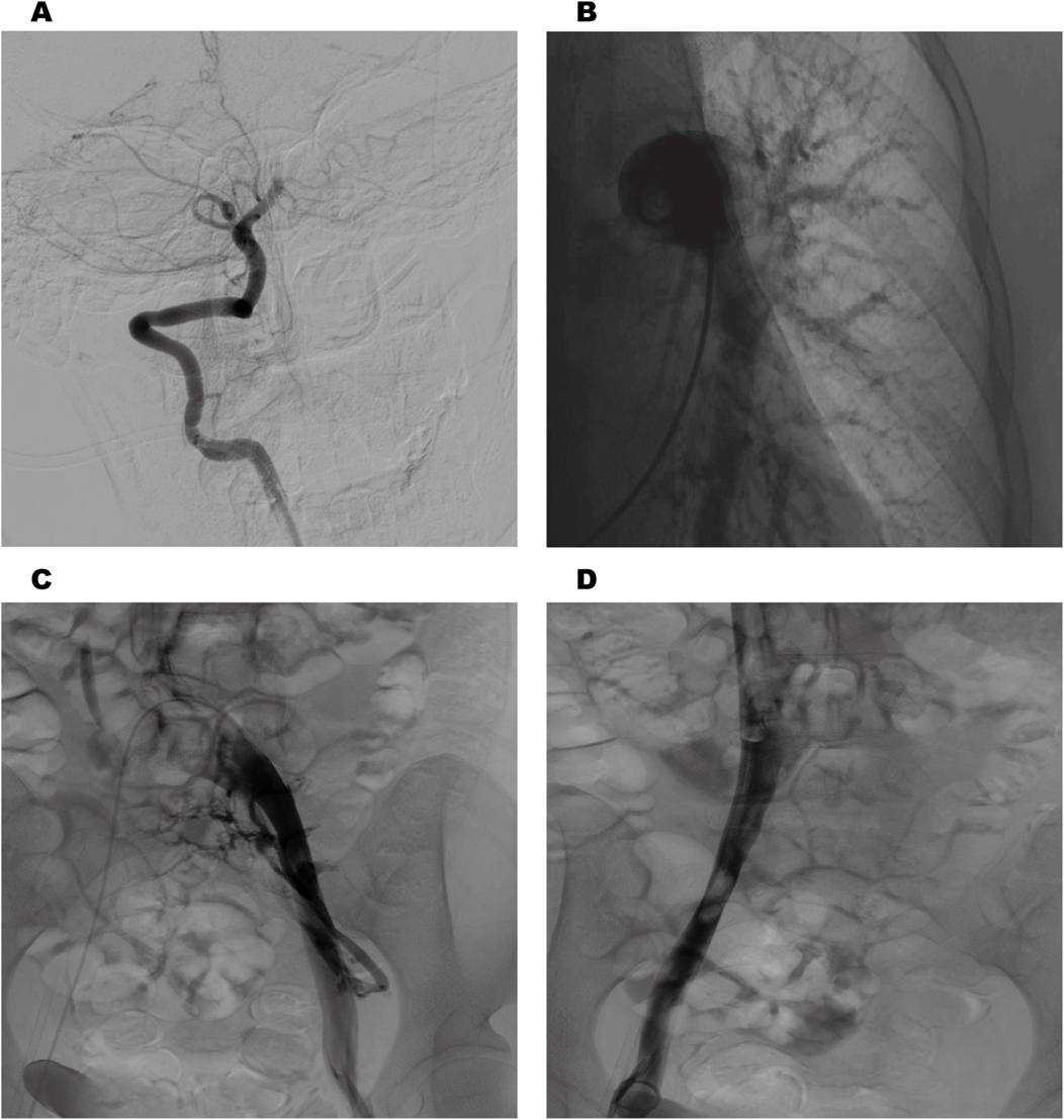 Four grayscale radiographic images labeled A to D. Image A shows a detailed view of a curved blood vessel. Image B depicts a darkened, rounded area with branching structures. Images C and D focus on the abdominal area, highlighting a prominent central vessel against a background of soft tissue and bony structures.