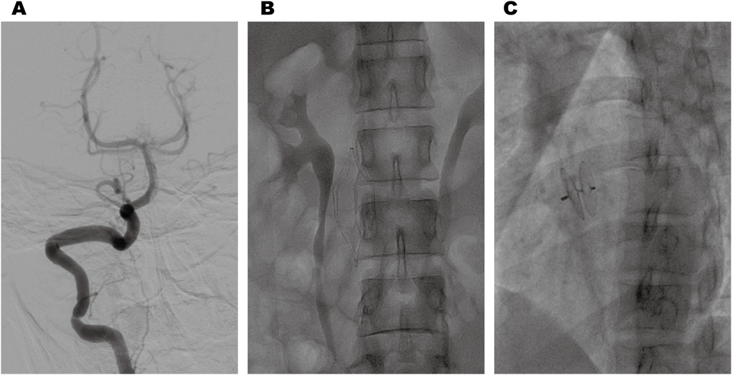 Panel A shows an angiogram of a cerebral artery with clear vascular structure. Panel B presents a lateral view X-ray of the lumbar spine showing vertebrae and intervertebral spaces. Panel C displays another spine X-ray with a visible surgical implant in the lumbar region.