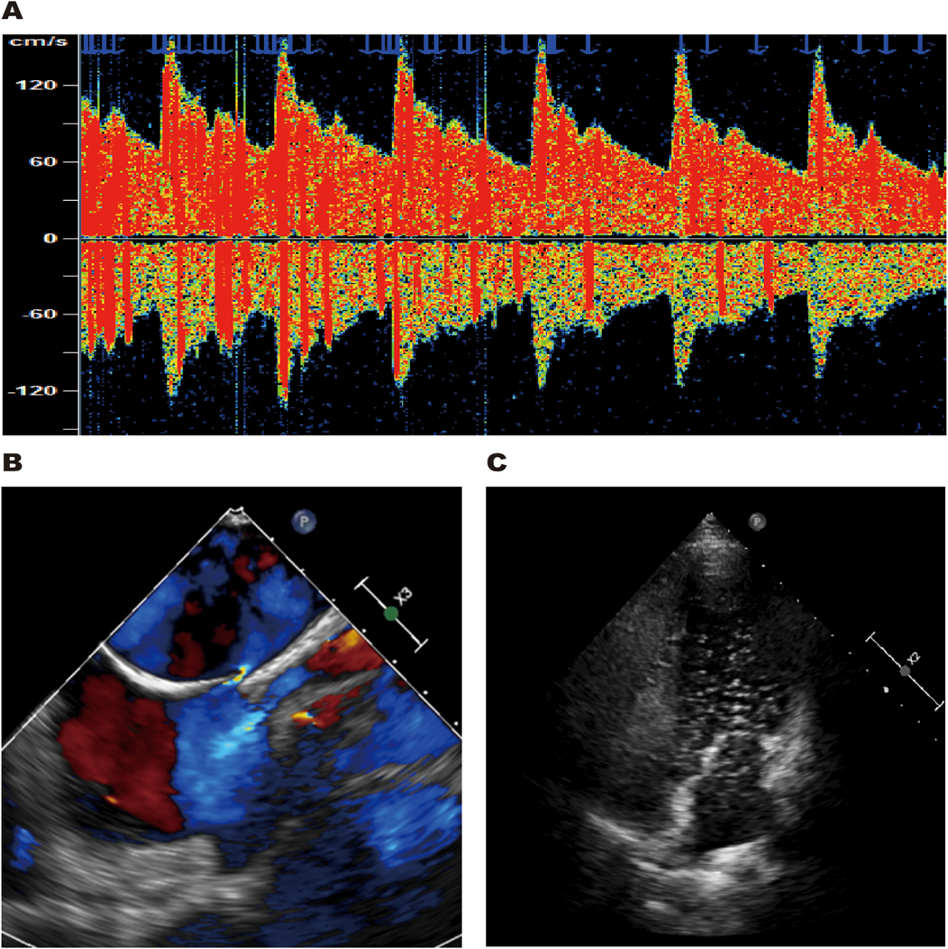 Panel A displays a color Doppler ultrasound image showing blood flow velocities in vibrant colors, with a scale ranging from negative one hundred twenty to one hundred twenty centimeters per second. Panel B shows a color Doppler echocardiogram illustrating blood flow in blue and red with anatomical structures in gray. Panel C presents a black and white echocardiogram image depicting cardiac anatomy without color flow information.