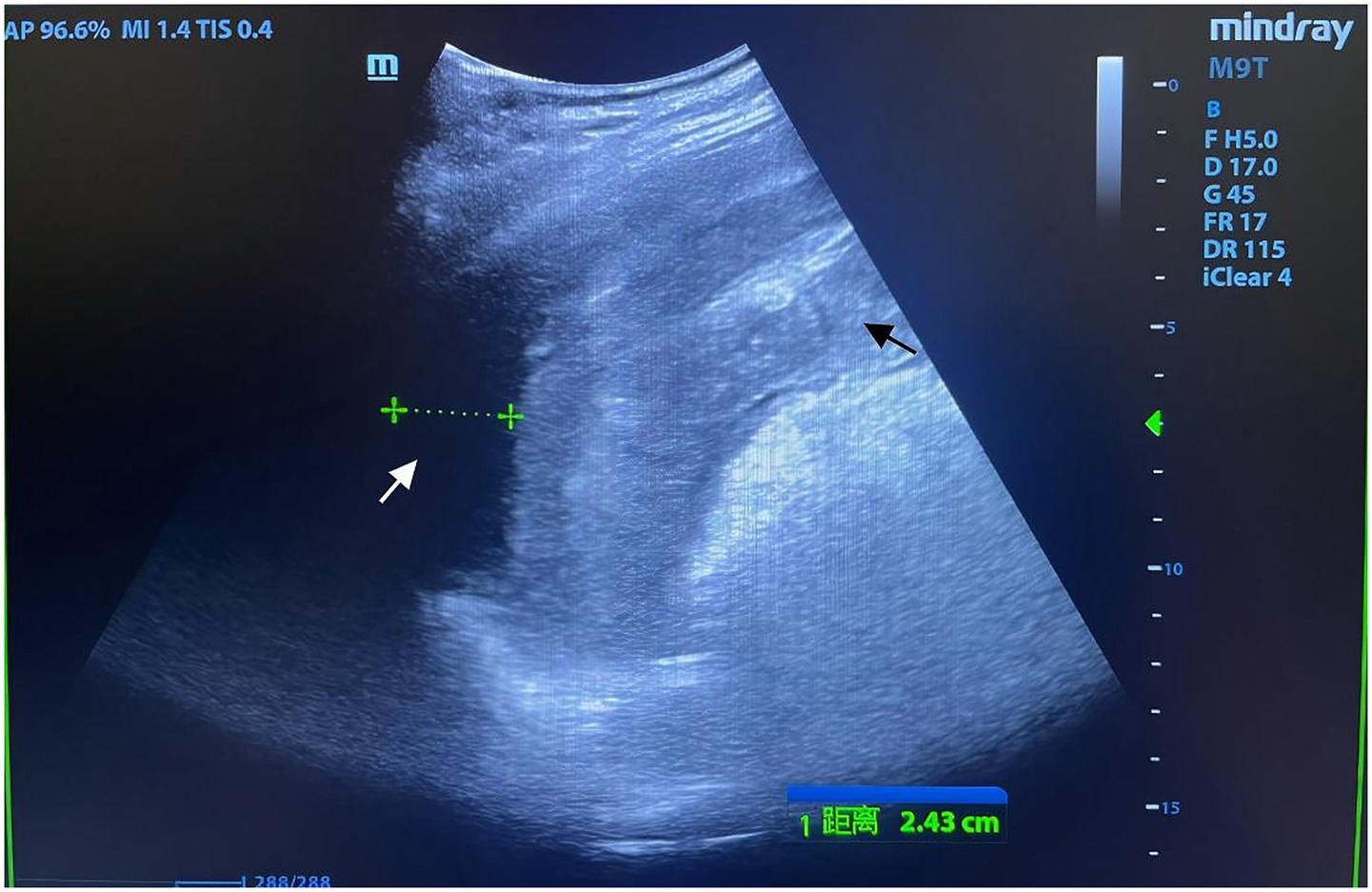 Ultrasound image showing a long-axis view of the inferior vena cava (IVC) with two arrows indicating its size measuring 2.43 centimeters. Annotations display system settings and measurements.