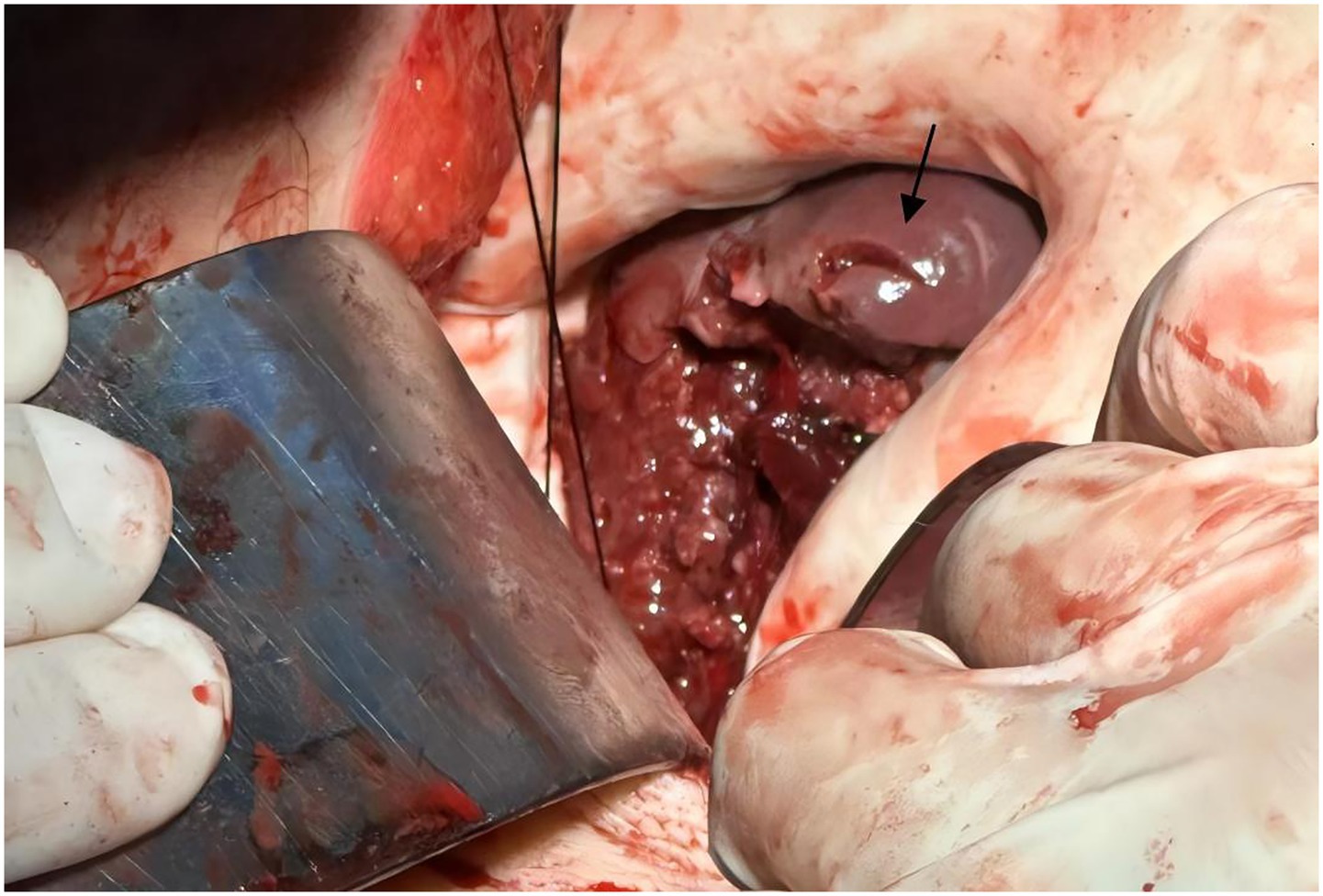 Surgical close-up of an operative site with gloved hands and a metal retractor, revealing abdominal organs. An arrow points to part of an organ, possibly indicating a specific area of focus.