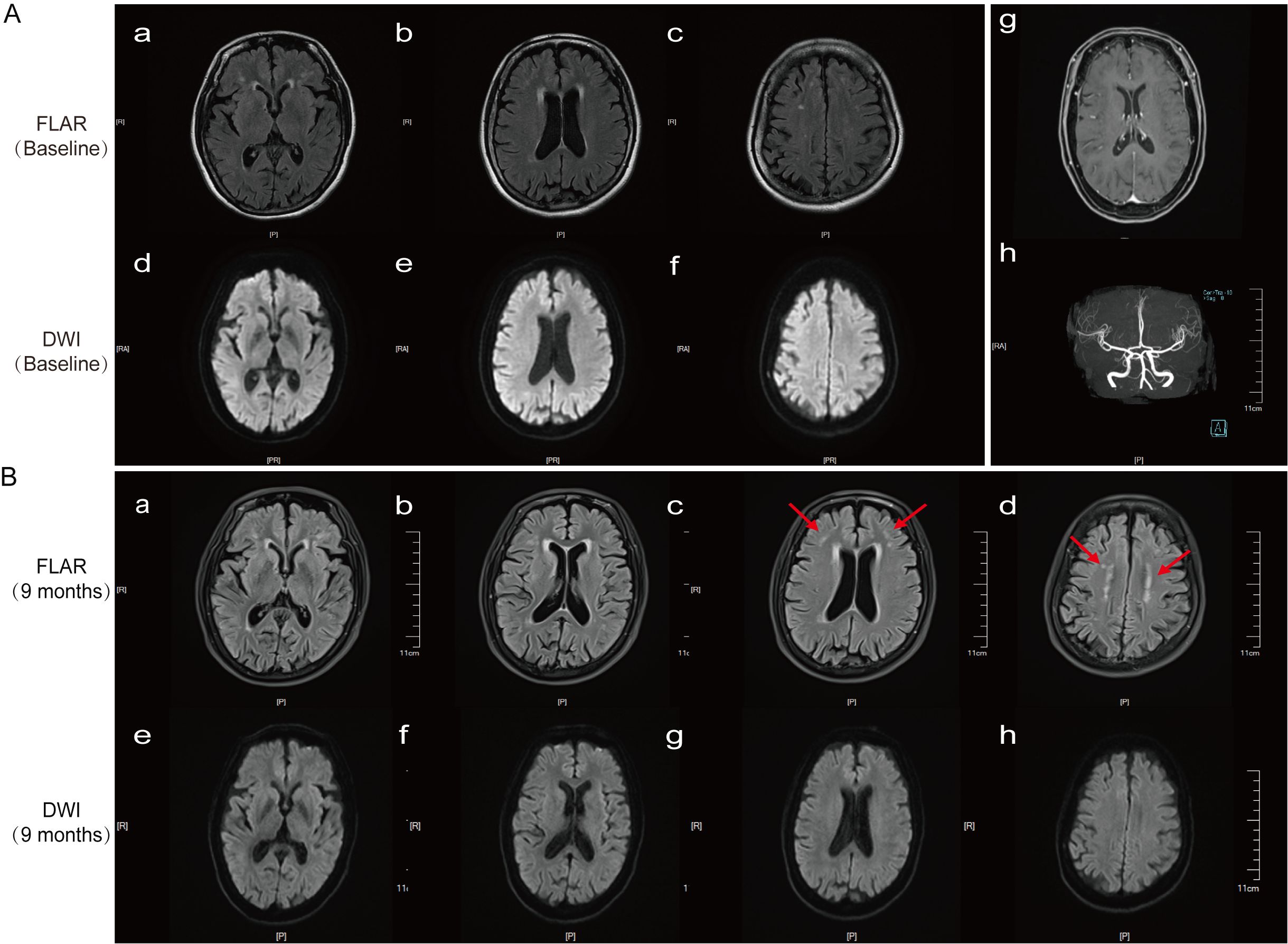 MRI scans showing two sets of images, labeled A and B. Set A includes baseline FLAIR and DWI images with no visible abnormalities. Set B shows FLAIR and DWI images after nine months. Red arrows in images Bc and Bd indicate areas of change or abnormalities. Images compare baseline and follow-up brain scans.