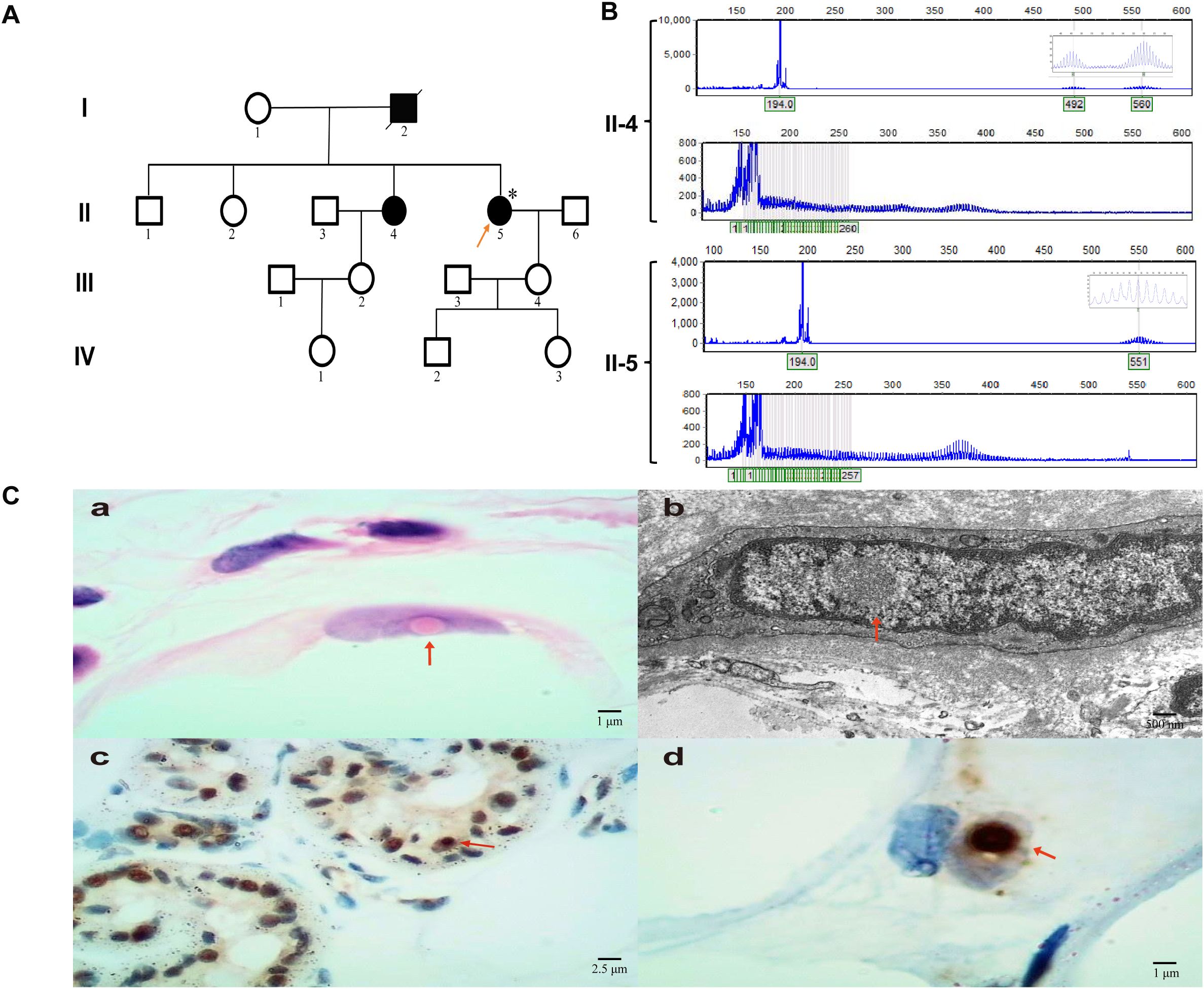 A genetic pedigree chart (Panel A) shows family inheritance with affected individuals marked in black, highlighting a particular family member with an asterisk. Graphs (Panel B) display genetic sequencing data for individuals II-4 and II-5. Histological images (Panel C) include a stained tissue section (a), an electron microscopy image (b) highlighting cellular structures, a histological sample showing multiple cell nuclei (c), and a magnified view of a stained cell with a prominent feature (d), marked by arrows.