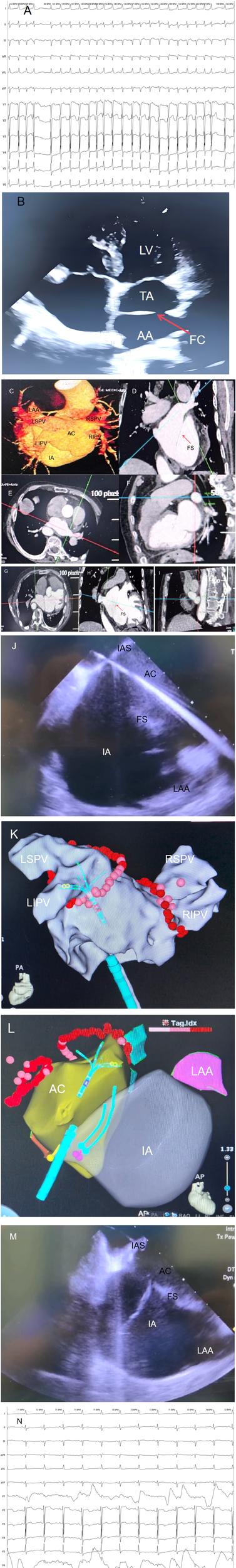 Two-panel clinical image showing cardiac evaluation. Panel A displays a 12-lead ECG with a regular, rapid, wide-complex tachycardia, suggestive of ventricular tachycardia with heart rates between 136 and 184 BPM. Panel B is an echocardiographic still image with labeled cardiac structures: LV (left ventricle), TA (thoracic aorta), AA (ascending aorta), and FC (fibrinous clot), indicated by a red arrow. The image suggests structural assessment and identification of intracardiac pathology. Composite image of cardiac CT scans displaying various anatomical views and labeling key cardiovascular structures. Panel C shows a 3D reconstruction with labels for the left atrial appendage (LAA), left superior pulmonary vein (LSPV), left inferior pulmonary vein (LIPV), right superior pulmonary vein (RSPV), right inferior pulmonary vein (RIPV), ascending aorta (AC), and innominate artery (IA). Panels D, H, and G include arrows indicating FS (filling structure or suspected filling defect). Panels E, F, and I present axial and sagittal CT slices with multi-planar reconstruction lines, used for orientation and precise localization. These images suggest detailed cardiac and vascular assessment. Two-panel image illustrating cardiac imaging and anatomical mapping. Panel J is an echocardiographic image showing key labeled structures: interatrial septum (IAS), ascending aorta (AC), filling structure (FS), innominate artery (IA), and left atrial appendage (LAA), suggesting evaluation of intracardiac and vascular anatomy. Panel K is a 3D electroanatomic map of the left atrium and pulmonary veins, with the left superior (LSPV), left inferior (LIPV), right superior (RSPV), and right inferior pulmonary veins (RIPV) labeled. Red and pink markers indicate ablation points around the vein ostia, commonly used in atrial fibrillation catheter ablation procedures. Two-panel image comparing 3D anatomical mapping and echocardiographic imaging of cardiac structures. Panel L shows a 3D electroanatomical reconstruction highlighting the ascending aorta (AC), innominate artery (IA), and left atrial appendage (LAA), with red and pink markers indicating ablation sites. Catheter positions are represented by blue lines and circles. Panel M is a transthoracic echocardiographic image labeling the interatrial septum (IAS), ascending aorta (AC), a filling structure (FS), innominate artery (IA), and left atrial appendage (LAA), used for real-time anatomical visualization during cardiac procedures. Twelve-lead ECG tracing labeled "N" showing a regular sinus rhythm at approximately 71\x9674 beats per minute. The limb leads (I, II, III, aVR, aVL, aVF) demonstrate normal P-wave morphology and consistent R-R intervals. The precordial leads (V1\x96V6) reveal notable ST-segment and T-wave abnormalities, particularly in leads V1 to V4, with deep T-wave inversions and possible ST-segment elevation, suggestive of anterior wall ischemia or evolving infarction.