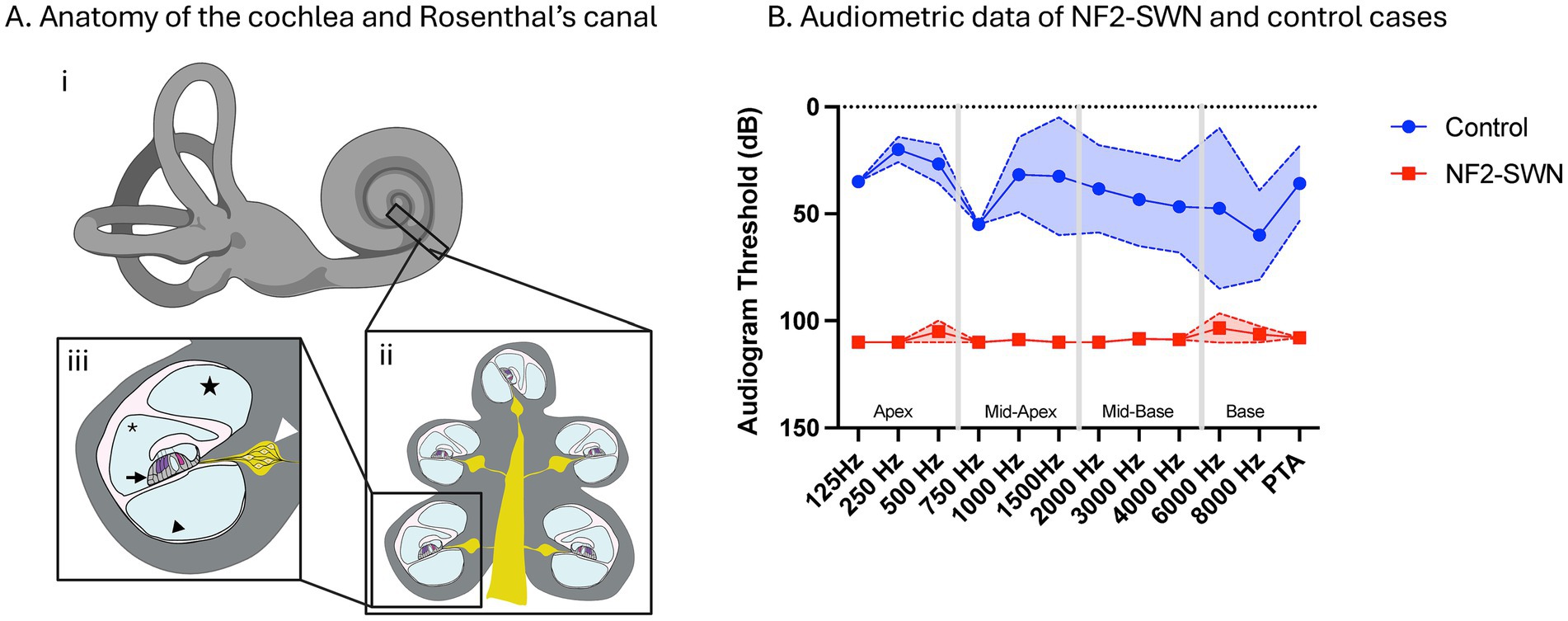 Anatomical diagram and chart. The left side illustrates the cochlea and Rosenthal's canal with labeled sections i, ii, and iii, highlighting detailed structures. The right side is a graph comparing audiometric data between NF2-SWN and control cases, showing control data as a blue line with shaded area and NF2-SWN data as a red line. Audiogram thresholds are plotted against frequencies from 125 Hertz to 8000 Hertz plus PTA, indicating differences in hearing levels.