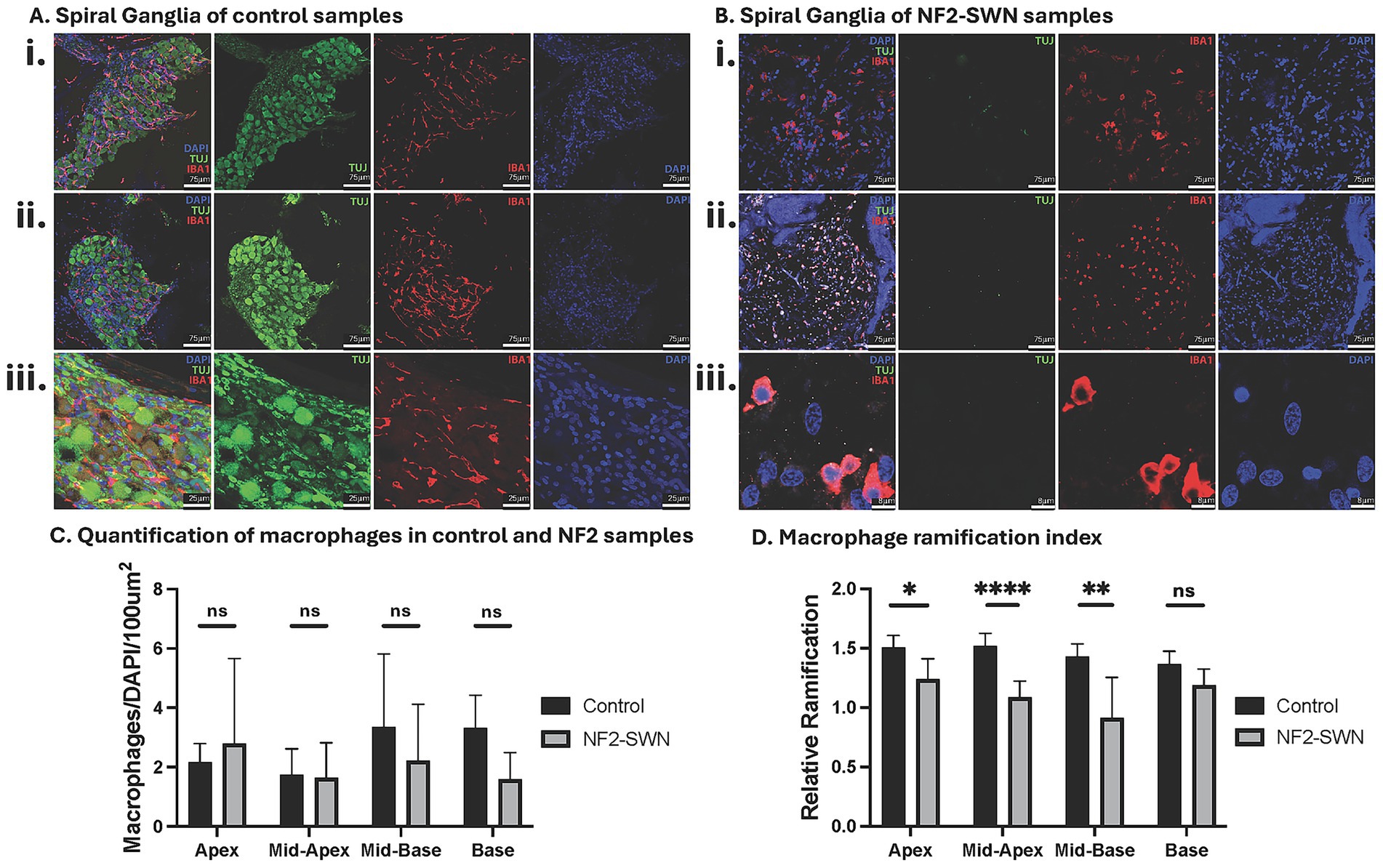 Microscopic images and bar graphs comparing control and NF2-SWN samples. Panel A and B show immunohistochemical staining of Rosenthal's canal with DAPI, TUJ and SOX10 markers. Panel A depicts control samples, while Panel B shows NF2-SWN samples. Panels i to iii display different sections at 20X, 20X, and 189X magnification respectively. Panel C and D present bar graphs quantifying macrophages and ramification indices respectively. Significant differences are indicated with asterisks.