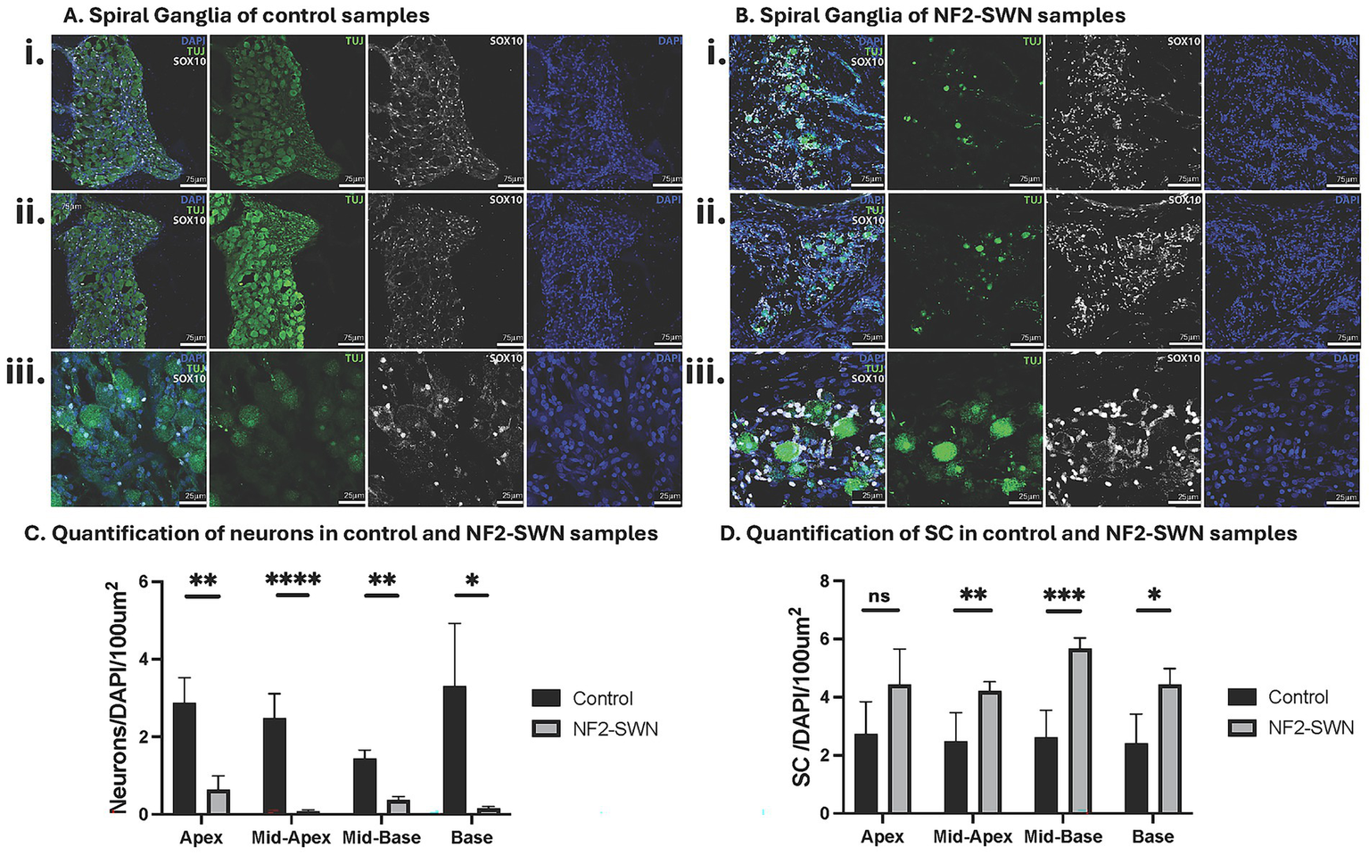 Microscopic images and bar graphs comparing control and NF2-SWN samples. Panel A and B show immunohistochemical staining of Rosenthal's canal with DAPI, TUJ and SOX10 markers. Panel A depicts control samples, while Panel B shows NF2-SWN samples. Panels i to iii display different sections at 20X, 20X, and 63X magnification respectively. Panel C and D present bar graphs quantifying neurons and Schwann Cells (SC) respectively. Significant differences are indicated with asterisks.