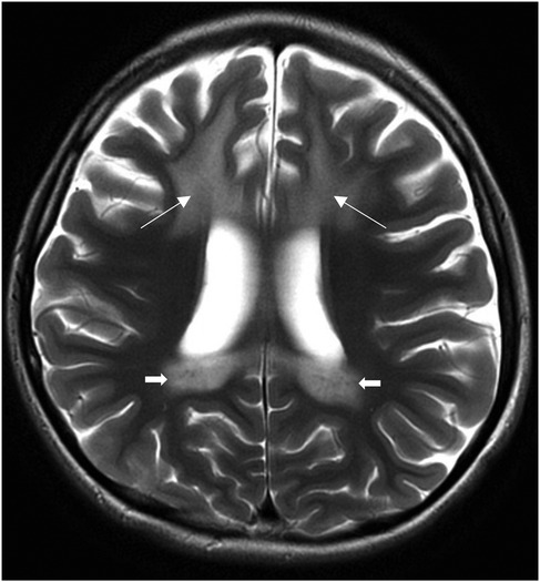 MRI of a brain showing white matter hyperintensities. Arrows highlight specific areas of increased signal intensity near the ventricles, suggesting possible periventricular white matter changes.