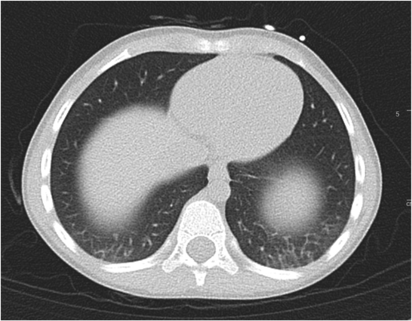 CT scan of the chest showing an axial view of the thoracic cavity. The image displays the lungs, vertebrae, and soft tissues, with a notable round lesion in the right lung.