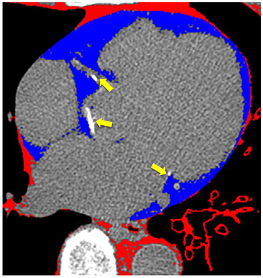 CT scan image highlighting parts of the abdomen with various colours. Gray areas indicate organs, black represents background, blue shows the fatty tisue around the heart and red outlines additional structures. Yellow arrows point to deposits of calcium within the arteries.