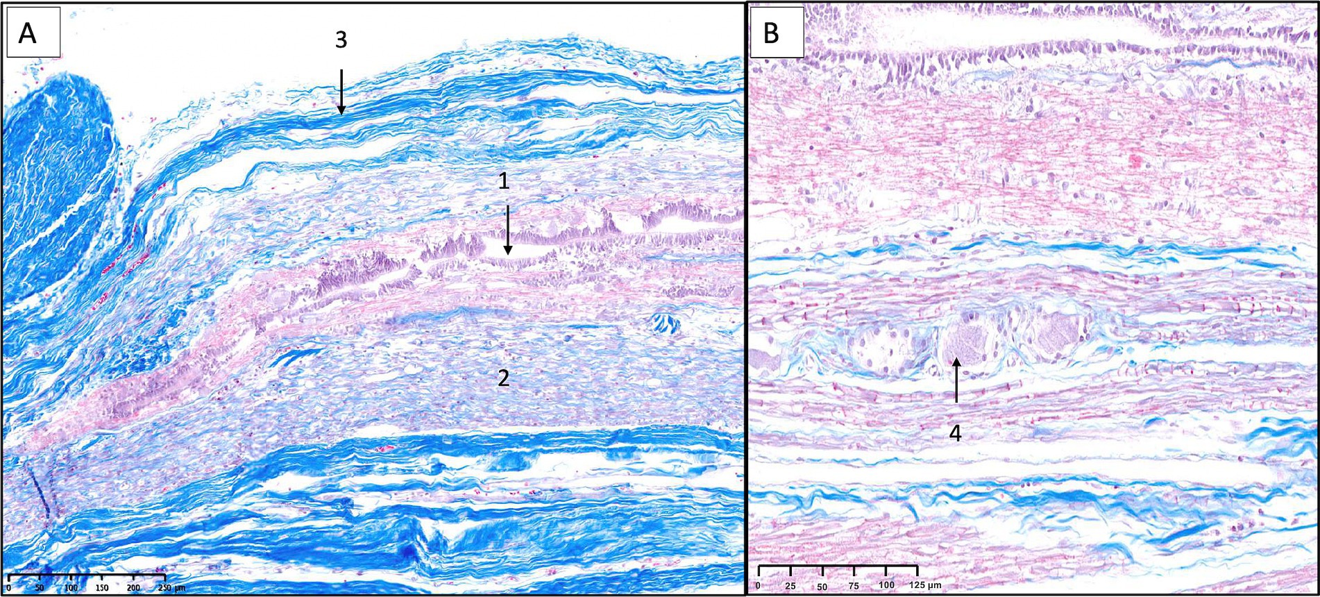 Sagittal Masson’s trichrome sections of the filum terminale internum. Panel A shows central canal, axonal bundles, neurons, and connective tissue layers. Panel B (higher magnification) shows isolated ganglion cells within collagen-rich connective tissue.