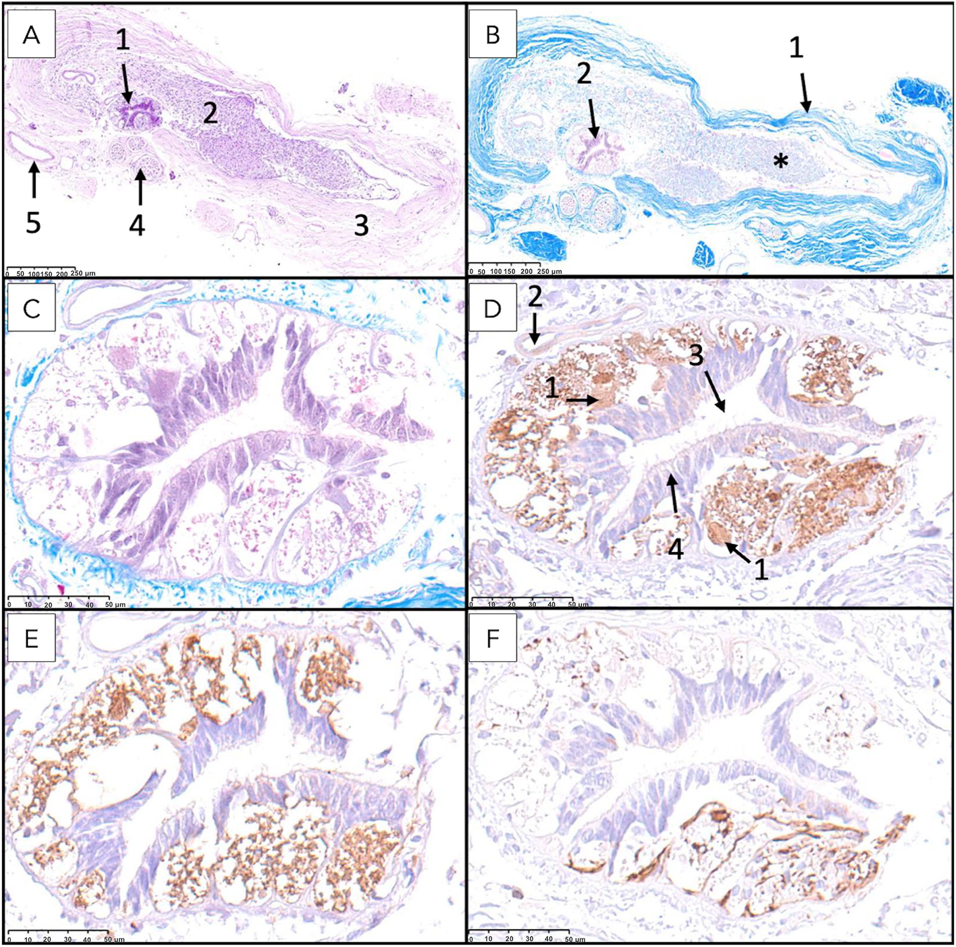 Histological and immunohistochemical transverse sections of the filum terminale internum at the S1–S2 level. Features include central canal, myelinated fibers, nerve roots, dura mater, and labeling for neurons (NSE, PGP 9.5) and astrocytes (GFAP).