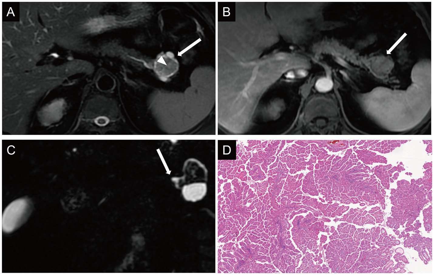MRI scans and a histological image depicted. Panels A, B, and C show MRI scans highlighting a mass in the pancreatic head. Panel D displays a histological section with papillary structures. Arrows and arrowheads indicate specific areas of interest in the scans.