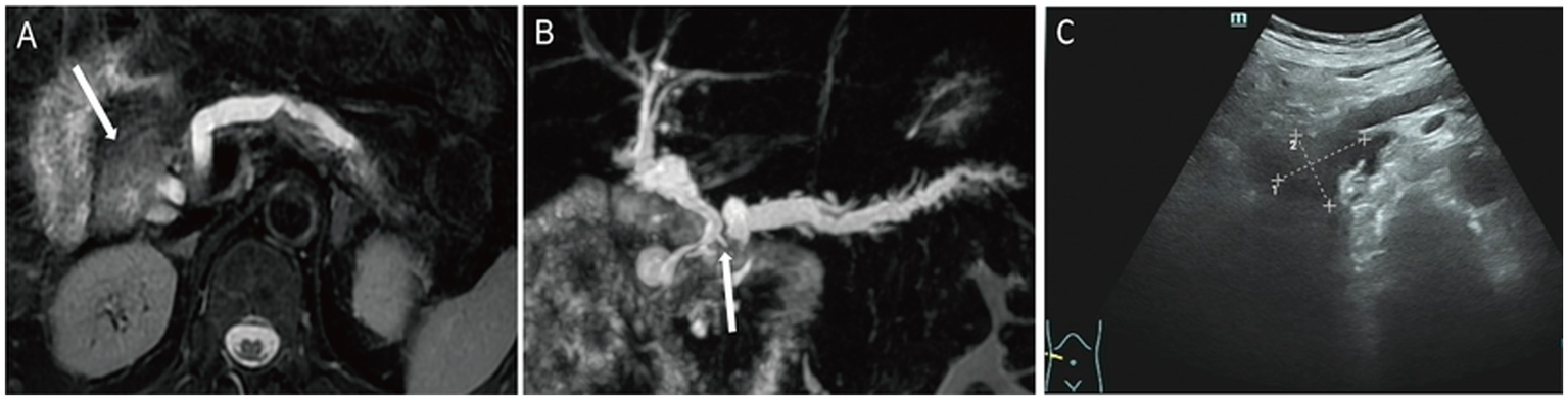 Three-panel medical imaging comprising: A) An MRI scan indicating a large area with an arrow; B) A similar MRI providing a different view, also highlighted by an arrow; C) An ultrasound image showing measurements of a structure within the body using dotted lines and crosses.
