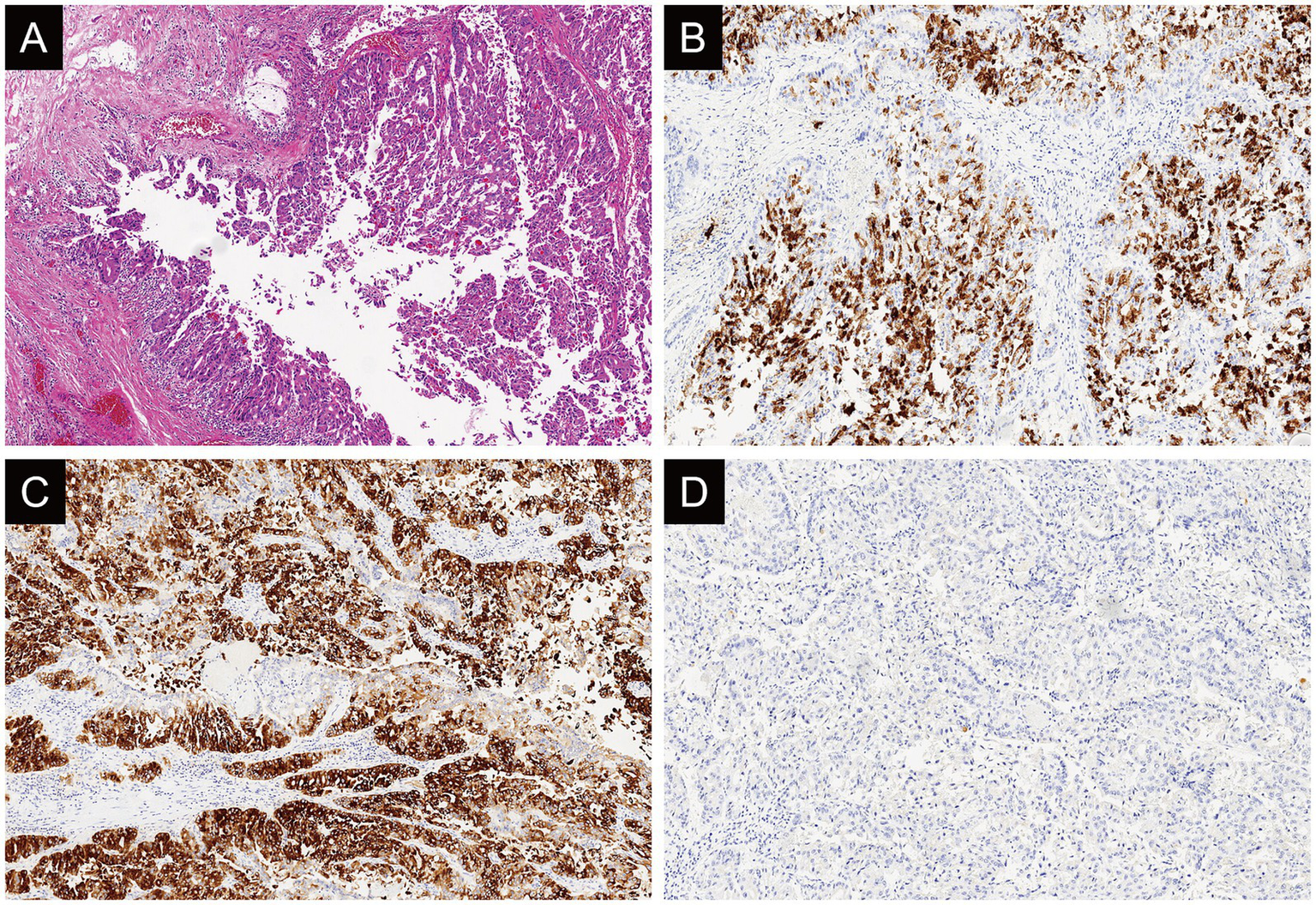 Histological images in a four-panel layout showing different tissue samples. Panel A displays intense pink and purple staining indicative of cellular structures. Panels B and C exhibit brown staining, suggesting immunohistochemical markers on cells with varying density. Panel D presents a lighter blue staining, indicating less marker presence compared to the previous panels. Each panel highlights different aspects of tissue morphology and marker expression.