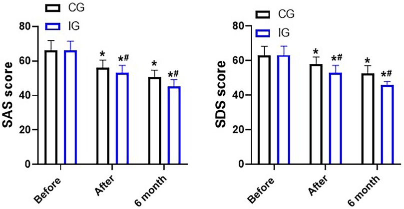 Bar graphs showing SAS and SDS scores for control group (CG) and intervention group (IG) at three time points: Before, After, and Six months. Both graphs depict a decrease in scores over time, with significant reductions marked by asterisks and hashtags.