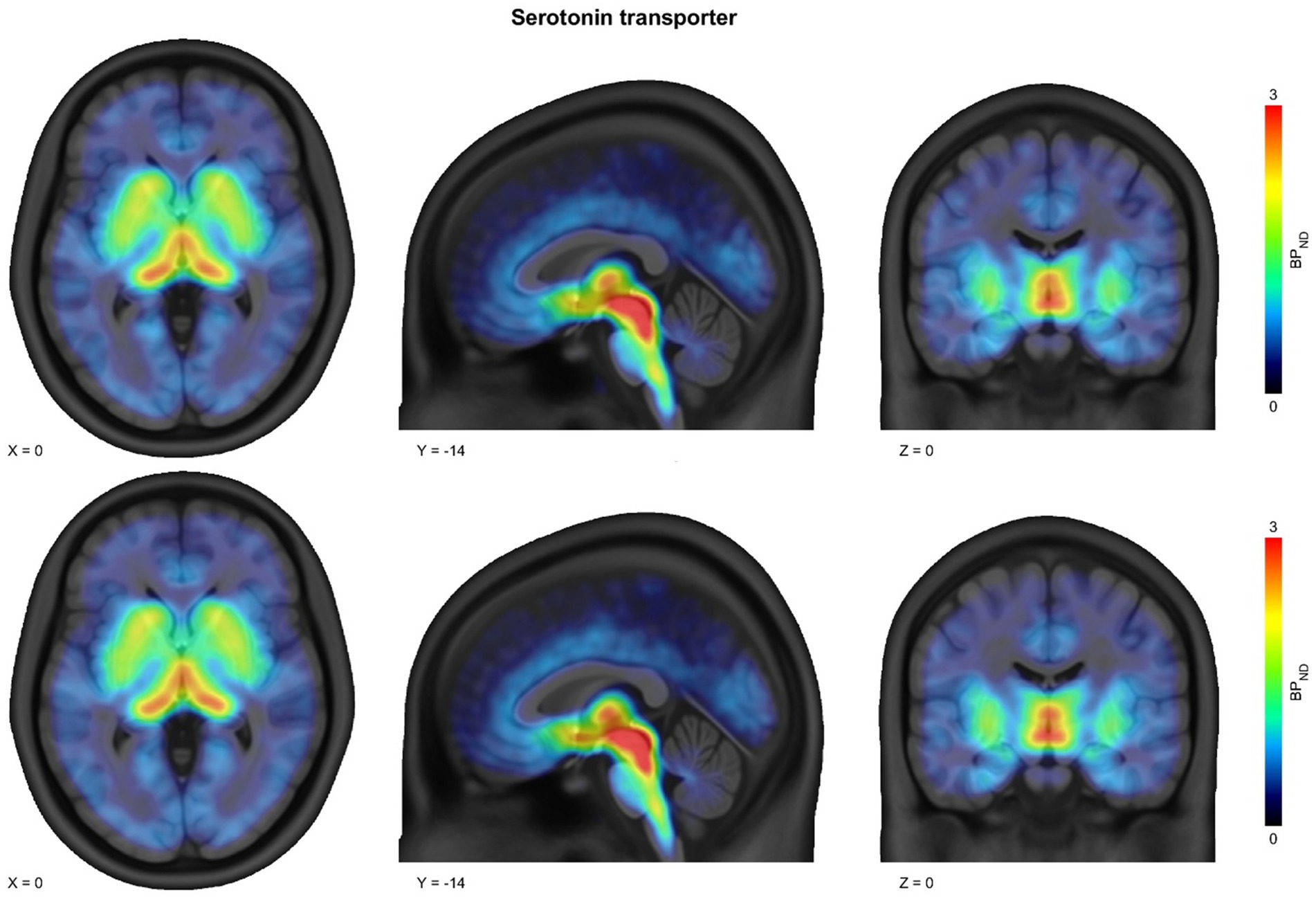 Brain scans showing serotonin transporter distribution in different slices. The top row displays axial, sagittal, and coronal views with coordinates X=0, Y=-14, Z=0, respectively. A color scale from blue to red represents increasing binding potential, with red indicating the highest concentration. The lower row repeats these views with similar patterns and coordinates.