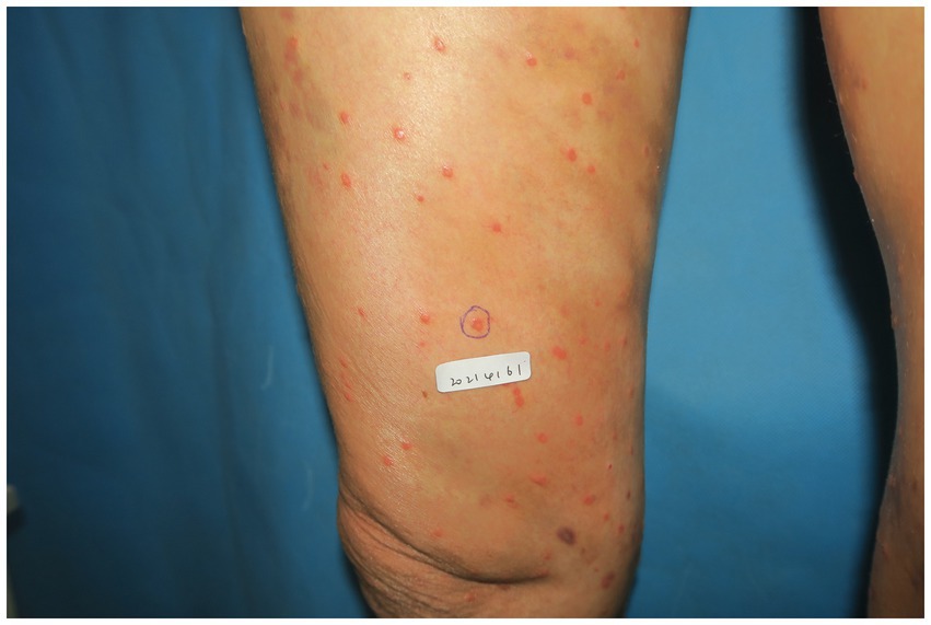 A leg with multiple small red spots, likely rashes or lesions, against a blue background. A circular mark is drawn around one spot, with a small label reading “20214161” nearby.