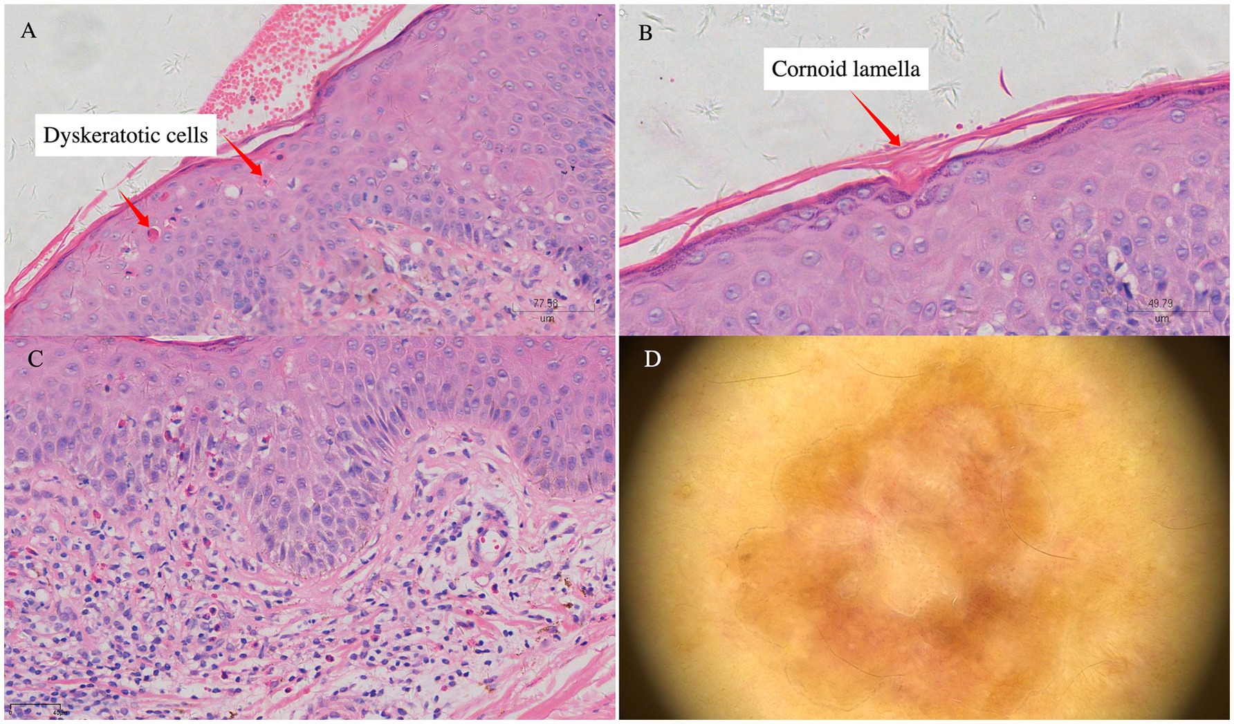Panel A displays a histology slide showing dyskeratotic cells labeled with arrows. Panel B shows a cornoid lamella indicated by an arrow. Panel C features skin tissue under a microscope without specific labels. Panel D presents a dermoscopic image of skin with a reddish-brown pattern.