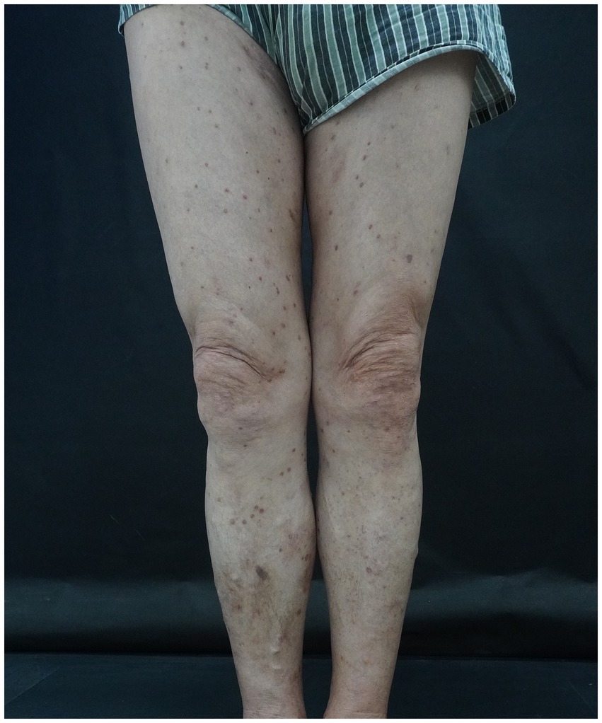 A pair of legs with visible skin discoloration and numerous dark spots, likely indicating a dermatological condition. The person is wearing striped shorts standing against a dark background.