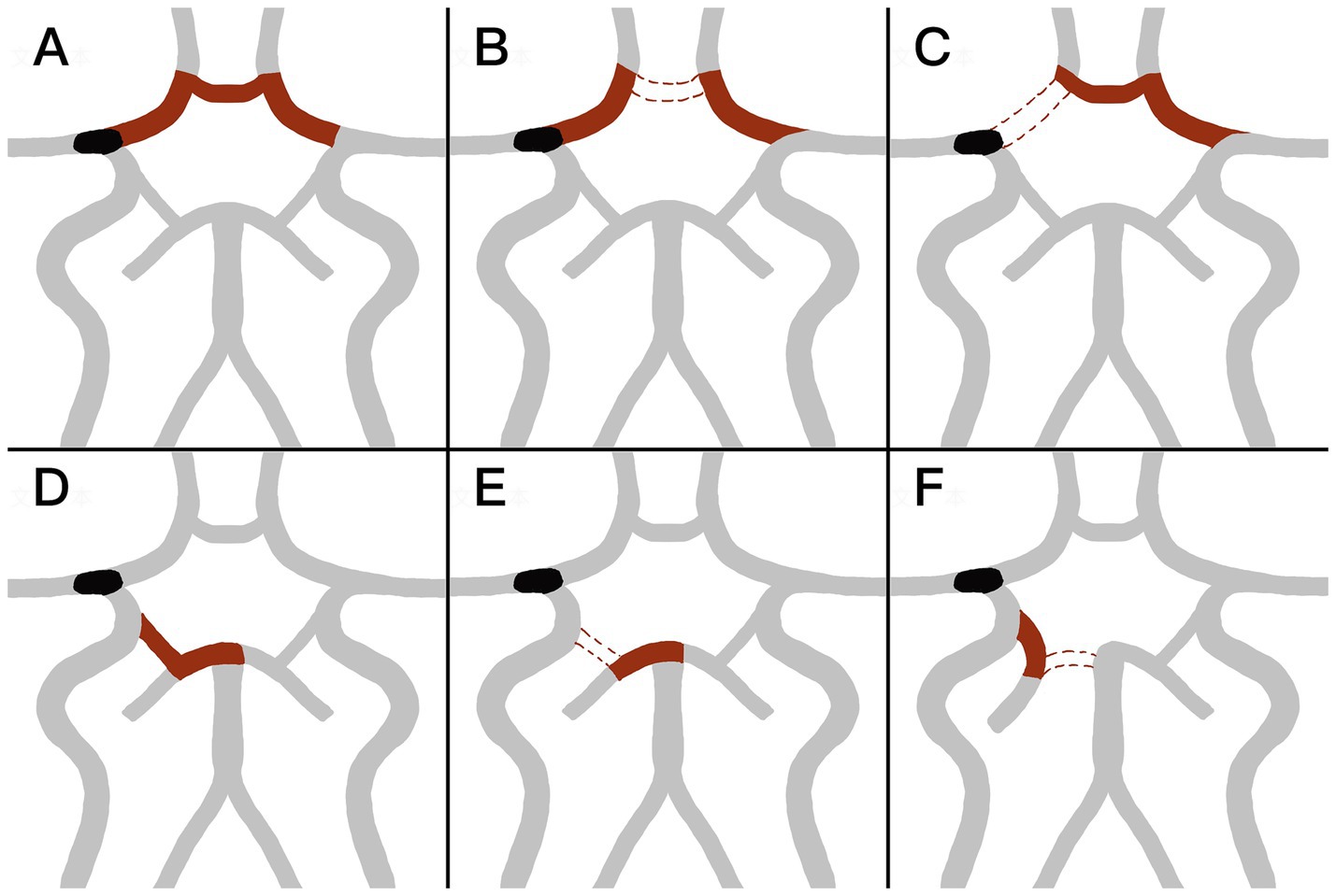 Diagram showing six panels labeled A to F, illustrating different configurations of blood vessels. Gray and red lines represent the vessels, with black sections indicating potential blockages or narrowings. Each panel displays unique patterns of branching and connections, suggesting variations in blood flow pathways.