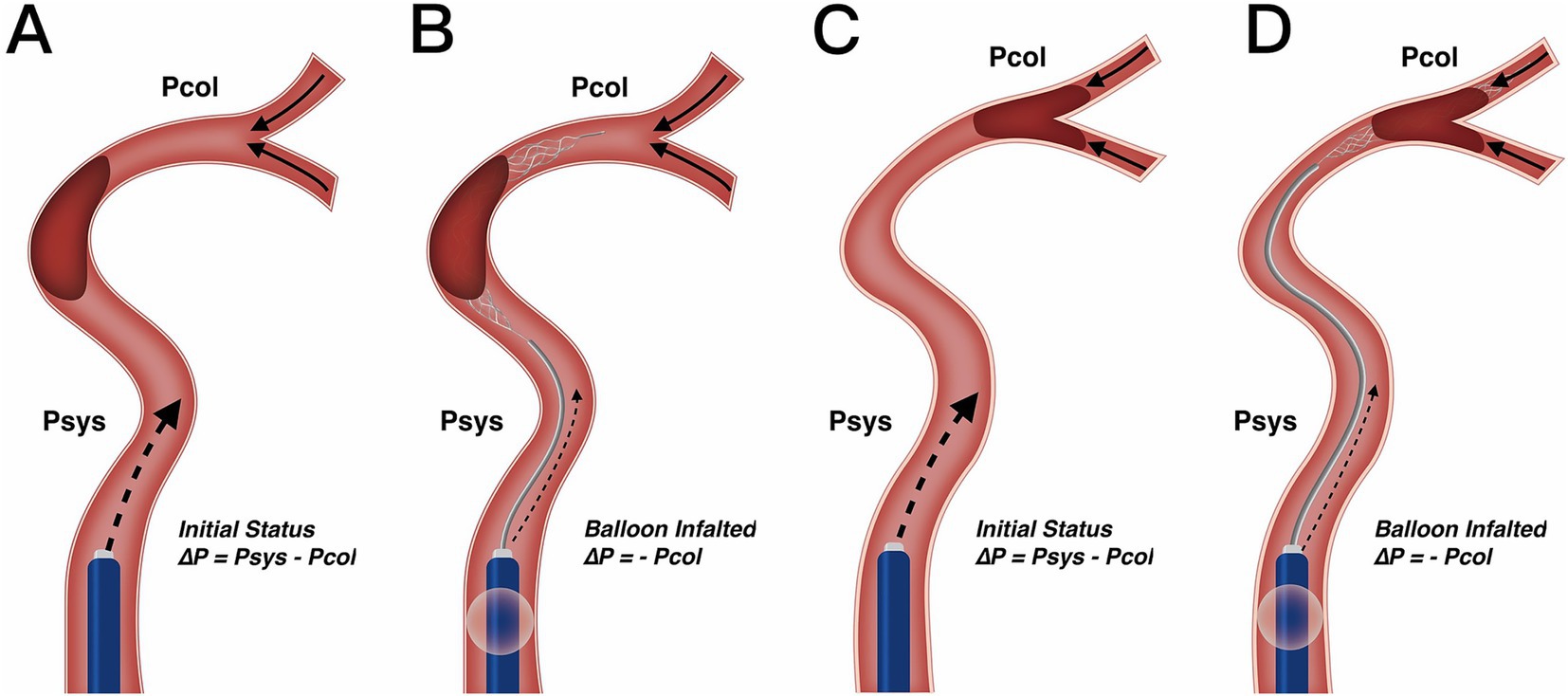 Diagram illustrating four stages of blood vessel balloon angioplasty. Panel A shows initial status with systolic pressure, Psys, and collateral pressure, Pcol. Panel B shows balloon inflation, equalizing pressure. Panel C returns to initial status. Panel D shows balloon inflation, equalizing pressure again. Arrows indicate blood flow direction within the vessel.