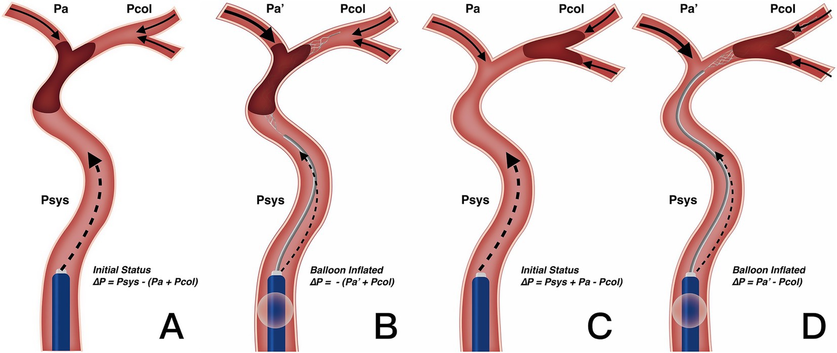 Diagram showing four stages of a stent and balloon procedure in a blood vessel. A and C illustrate initial status, with labels Pa, Psys, and Pcol. B and D show balloon inflation. Mathematical expressions detail pressure changes in each stage.