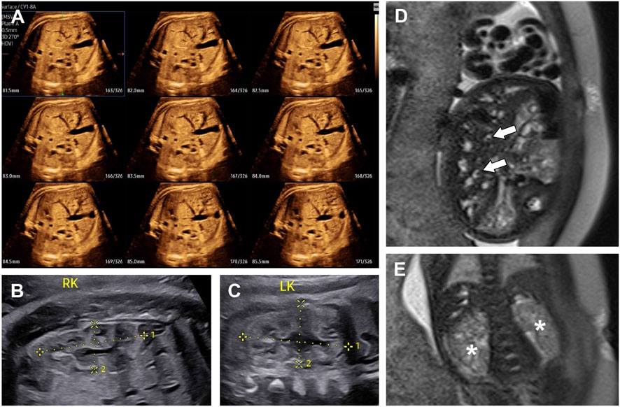 Ultrasound and MRI images of a 33+4-week fetus. Panel A shows an ultrasound multi-slice view of the liver displaying multiple small tubular and cystic anechoic structures (dilated bile ducts). Panels B and C are ultrasound images of the right and left kidneys, which appear echogenic with loss of corticomedullary differentiation. Panel D displays a T2-weighted MRI of the liver showing multiple dilated bile ducts and the 'central dot’ sign (arrows). Panel E is a T2-weighted MRI of the abdomen showing both kidneys (asterisks) with loss of corticomedullary differentiation and multiple tiny cysts.