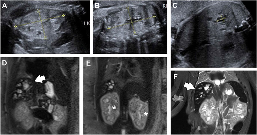 Prenatal and postnatal imaging of a 39-week fetus. Panels A and B show ultrasound images displaying enlarged, echogenic kidneys with lost corticomedullary differentiation. Panel C is an ultrasound image of the right liver lobe showing anechoic cystic lesions. Panel D displays a T2-weighted MRI of the fetal liver showing hyperintense cystic and tubular structures (arrows). Panel E is a T2-weighted MRI showing enlarged, cystic fetal kidneys (asterisks). Panel F displays a postnatal T2-weighted MRI confirming dilated intrahepatic biliary ducts (arrows) and enlarged, cystic kidneys (asterisks).