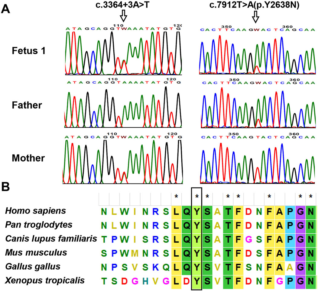 Genetic analysis of Family 1. Panel A shows Sanger sequencing chromatograms confirming the compound heterozygous PKHD1 variants: the c.3364+3A>T variant in the fetus and mother, and the c.7912T>A (p.Tyr2638Asn) variant in the fetus and father, with mutated sites marked by arrows. Panel B displays a multiple sequence alignment showing the tyrosine residue at position 2638 is highly conserved across various vertebrate species.